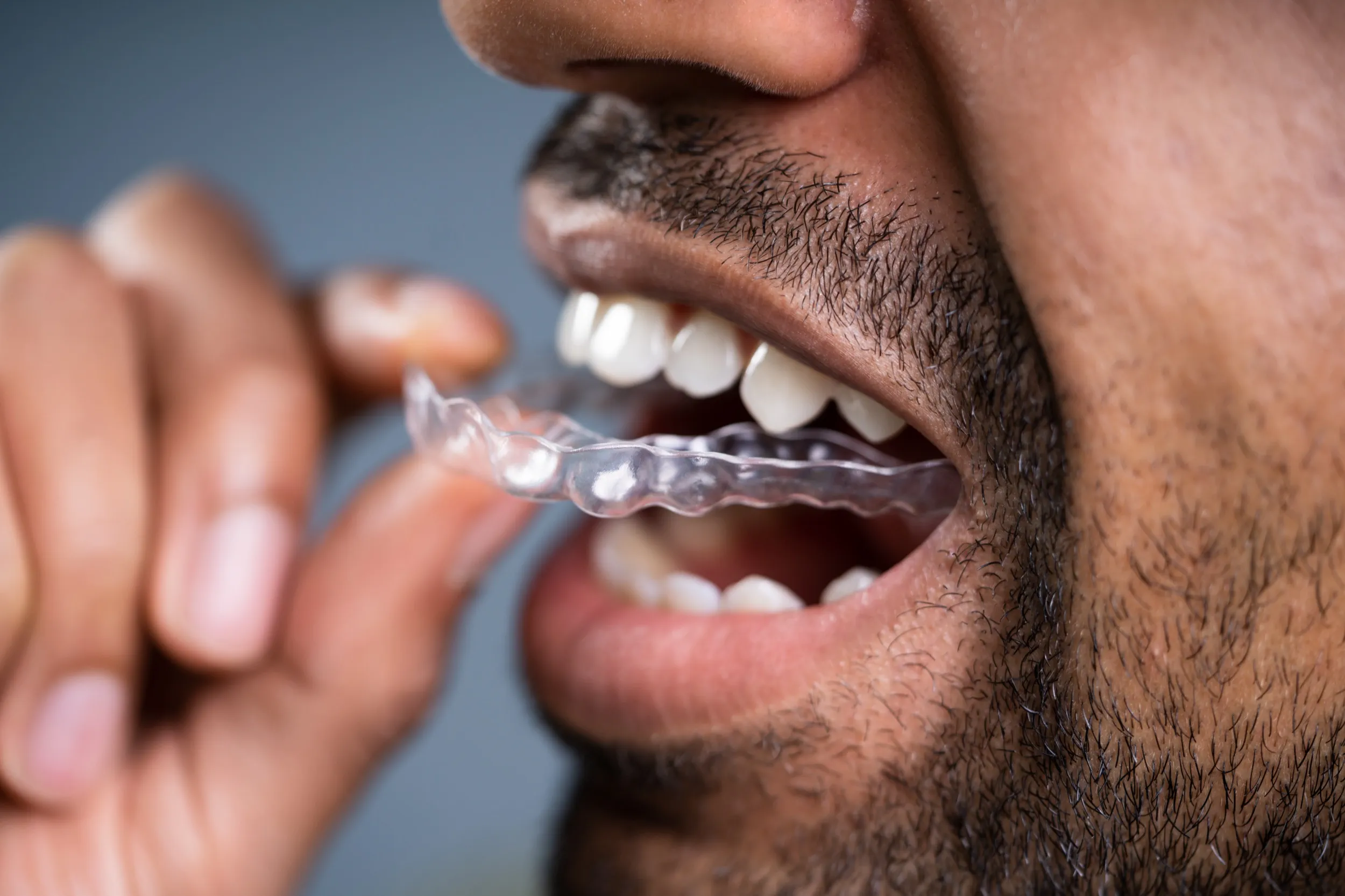 Clear dental aligner being placed on teeth by person with stubble