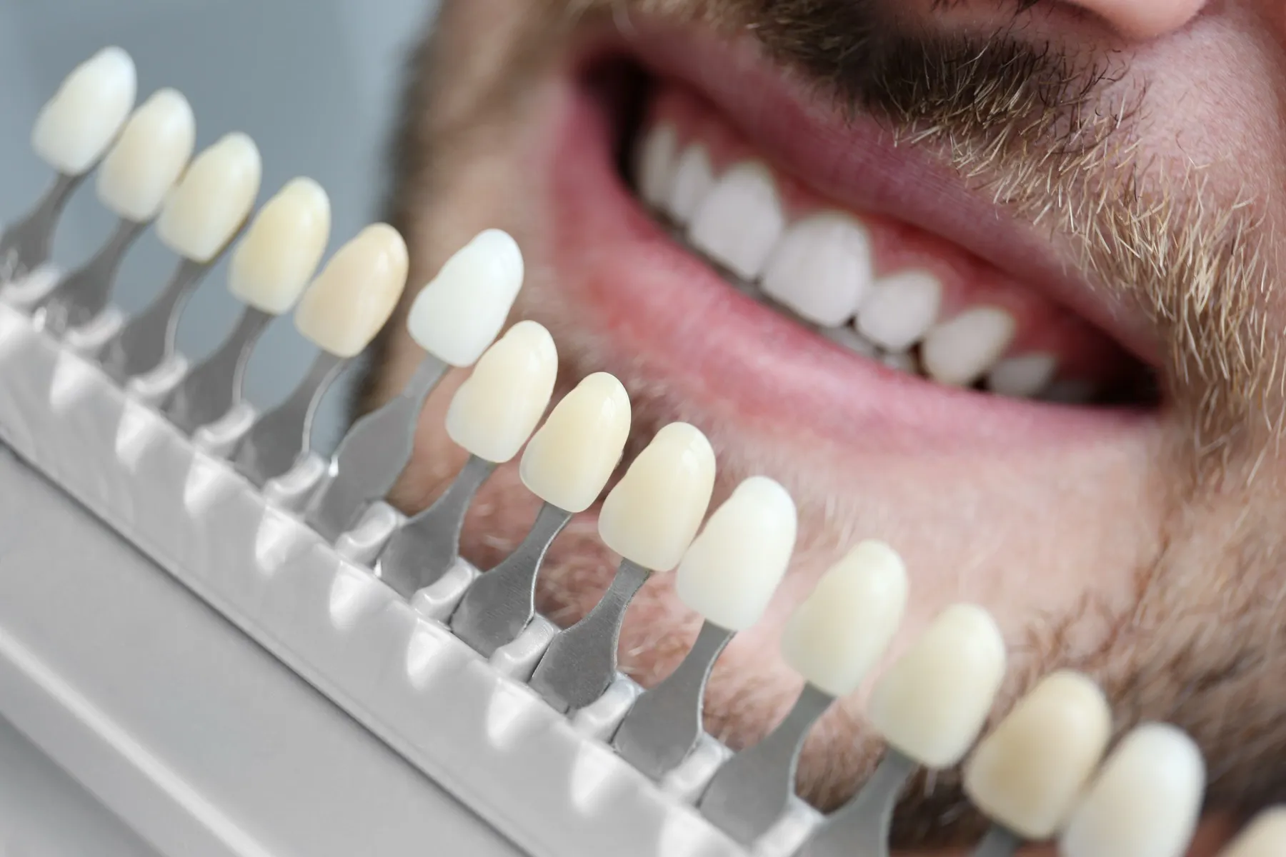 Dental shade guide comparing tooth color next to patient's teeth