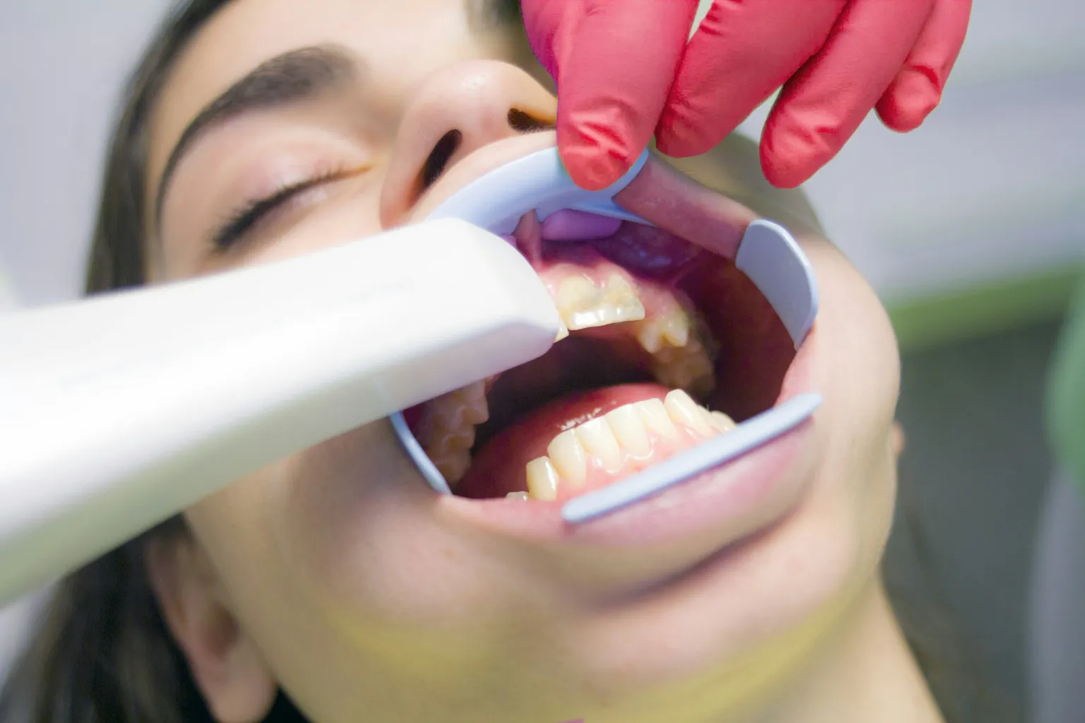 Scan numérique des dents d’une patiente au laboratoire Labo 57 à Cannes