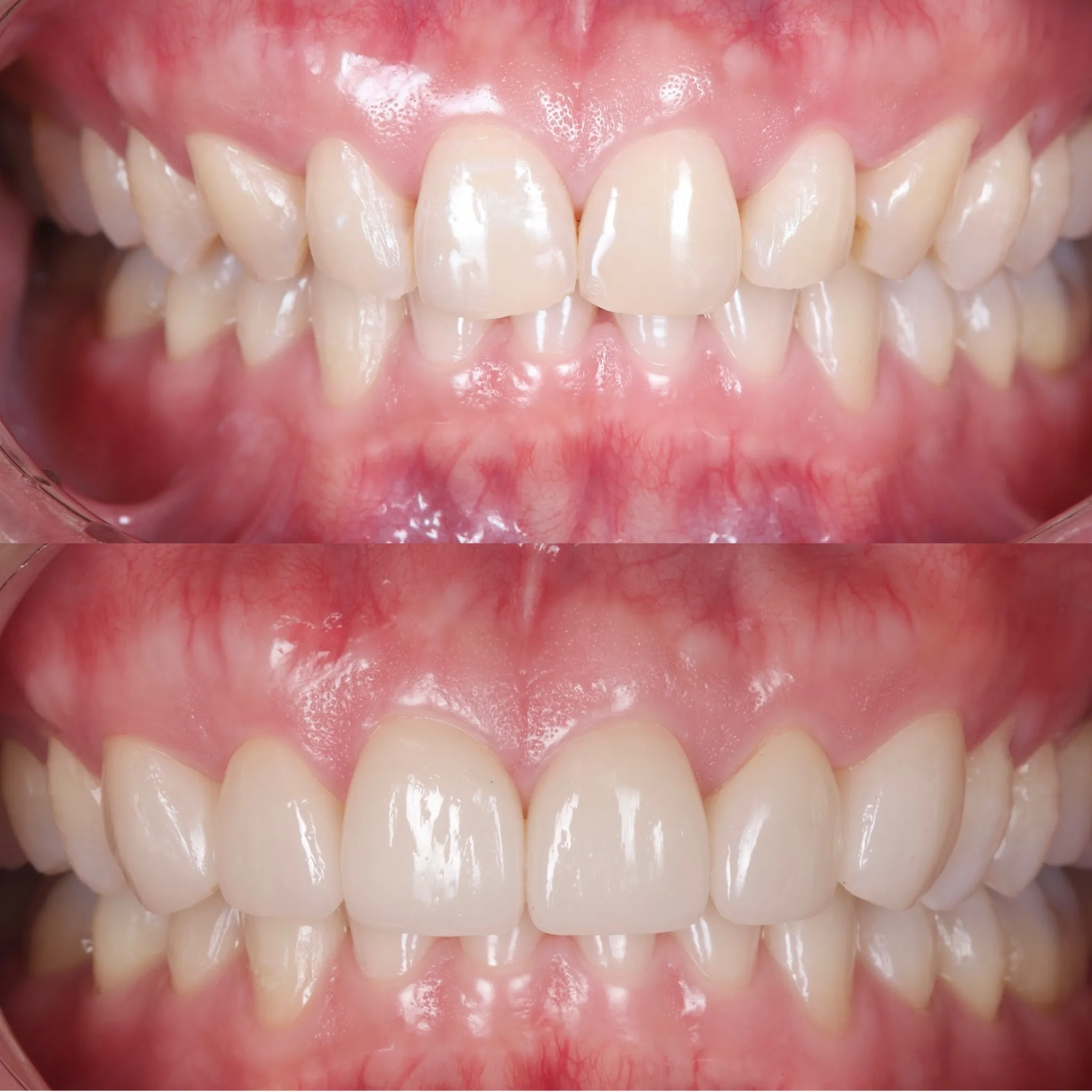 Dentition avant et après restauration prothétique réalisée par Labo 57 à Cannes