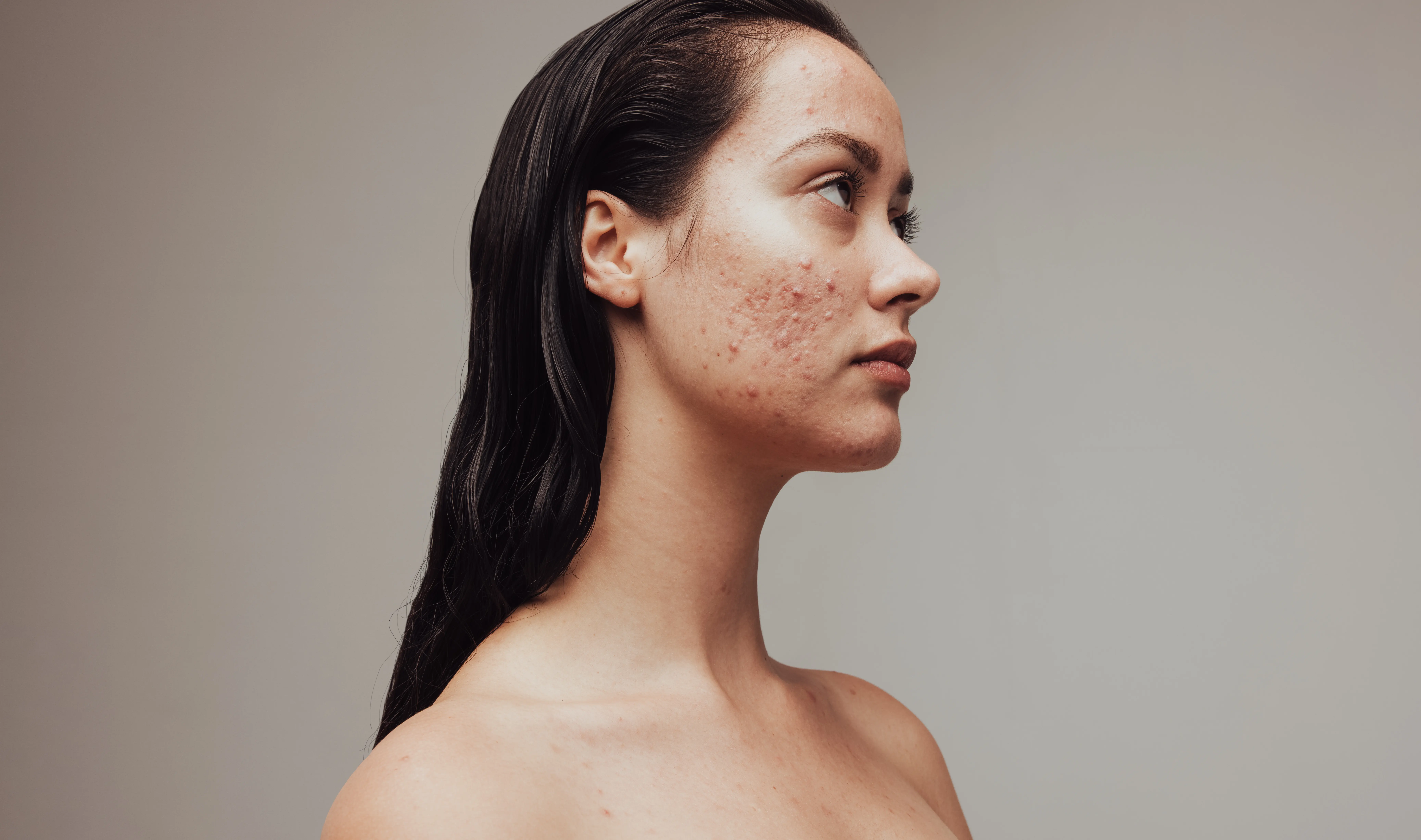 acne clarity program at dietMD Hawaii
