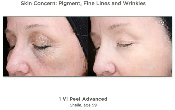 Vi Peel Results 4