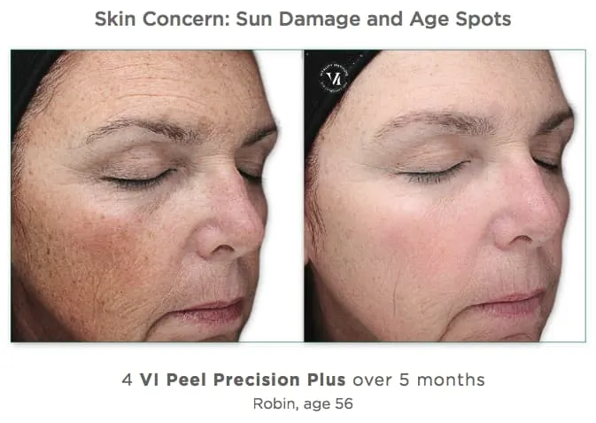Vi Peel Results 2
