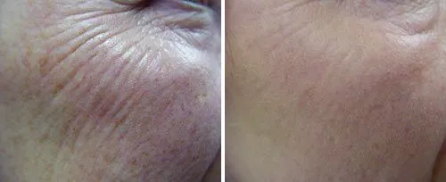 Fotona Skin Resurfacing 2