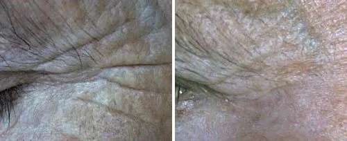 Fotona Skin Resurfacing 1