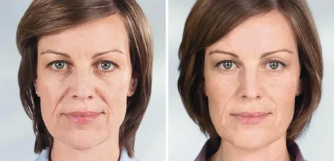 Radiesse vs Sculptra