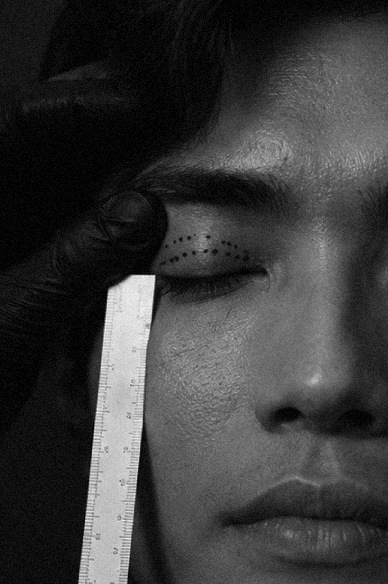 An image of a patient in preparation of an upper eyelid blepharoplasty with Dr. Paul Denton at Refine Cosmetic Surgery in Vancouver, BC