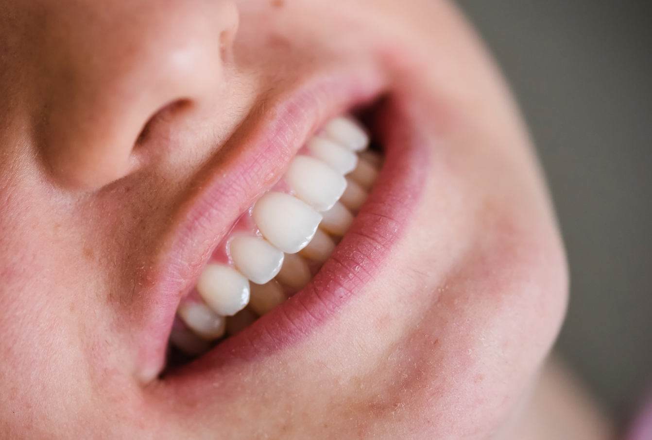 Dental whitening treatment setup