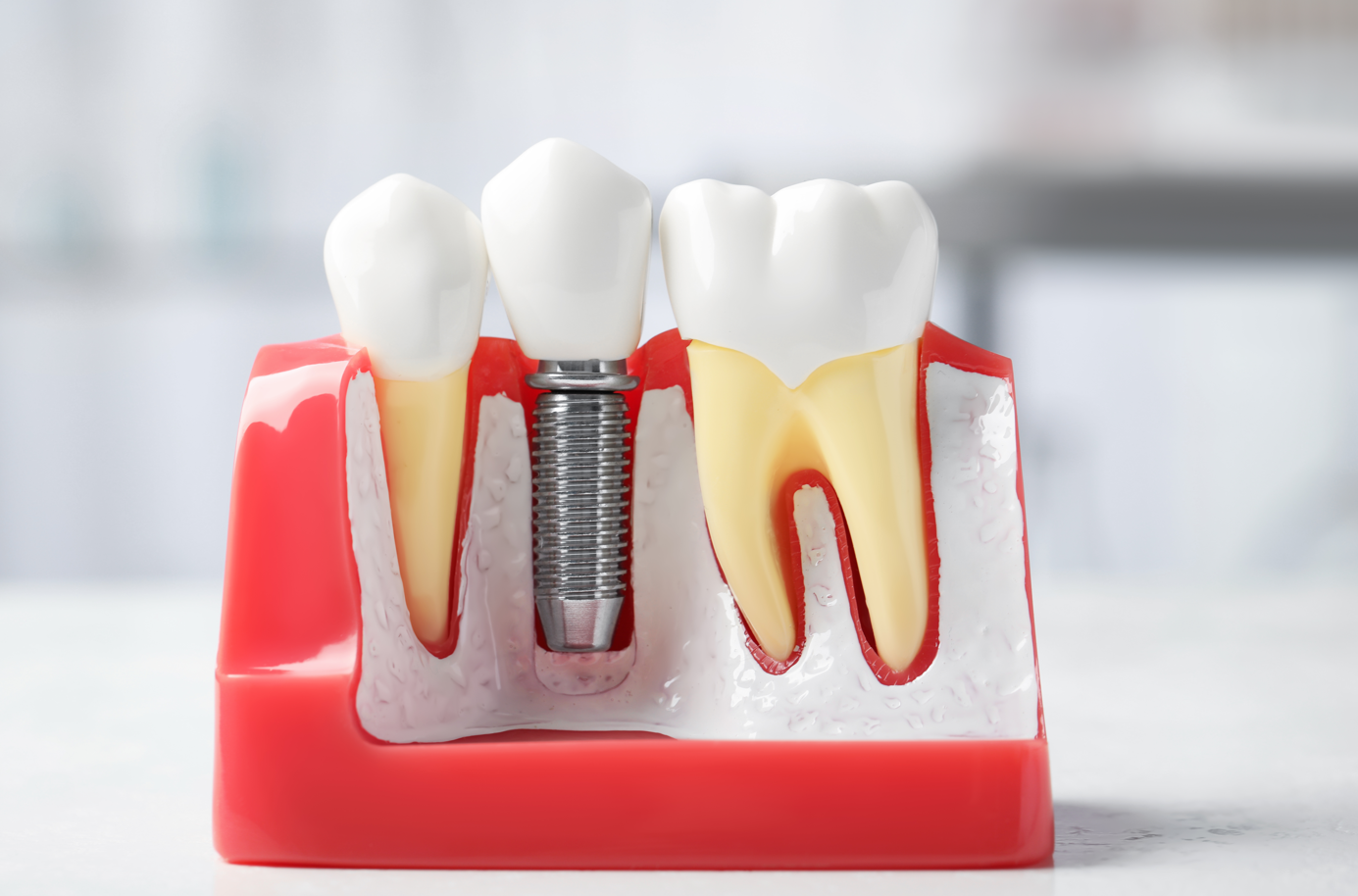 A dental model demonstrating a tooth implant positioned between two natural teeth on a red base. — Clio Dental Studio