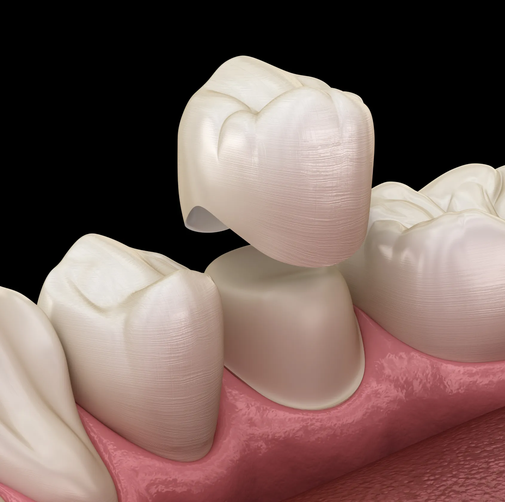 A dental crown is being placed over a prepared tooth in a person's mouth.