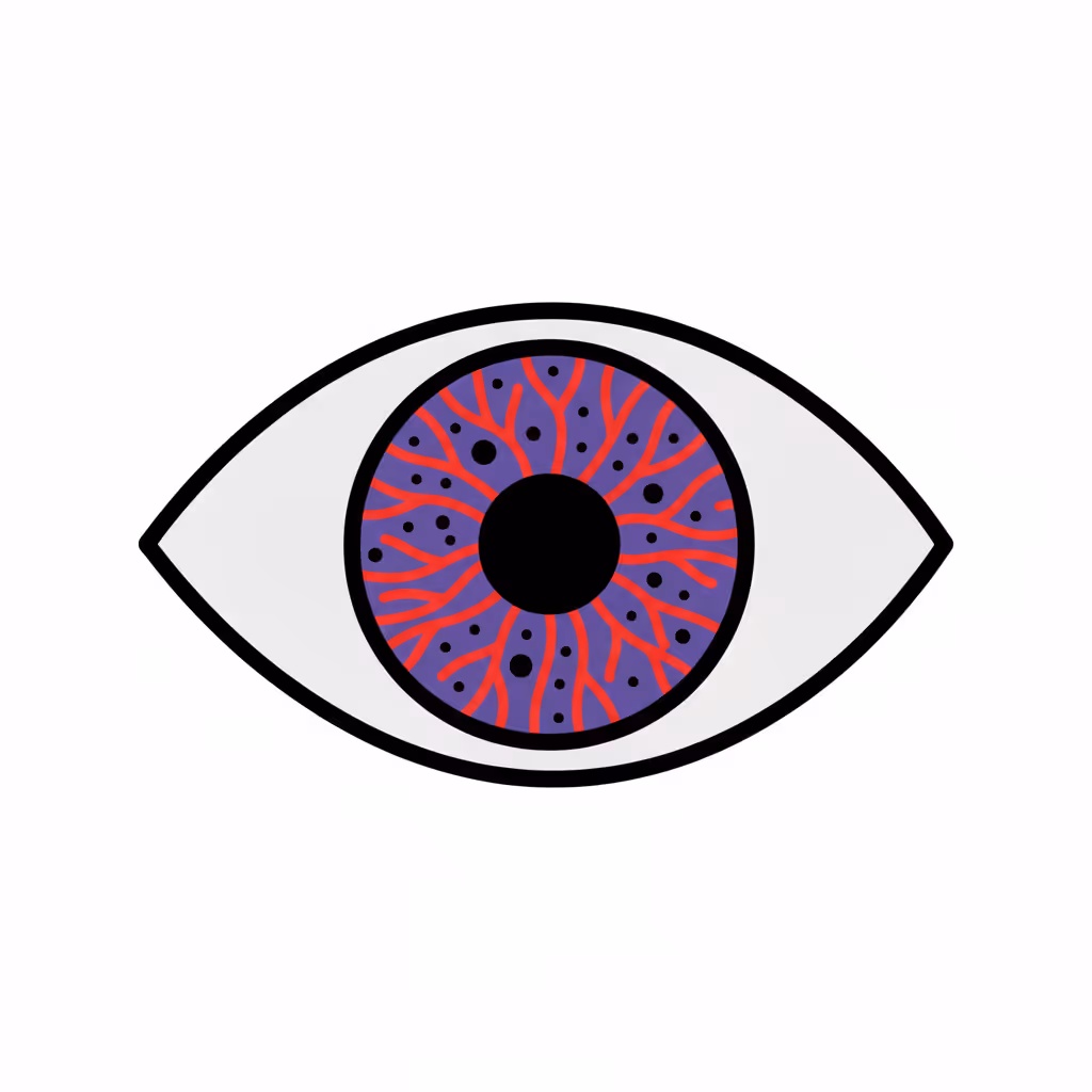Illustration of an eye with a purple iris showing red inflamed blood vessels and black spots, representing uveitis.