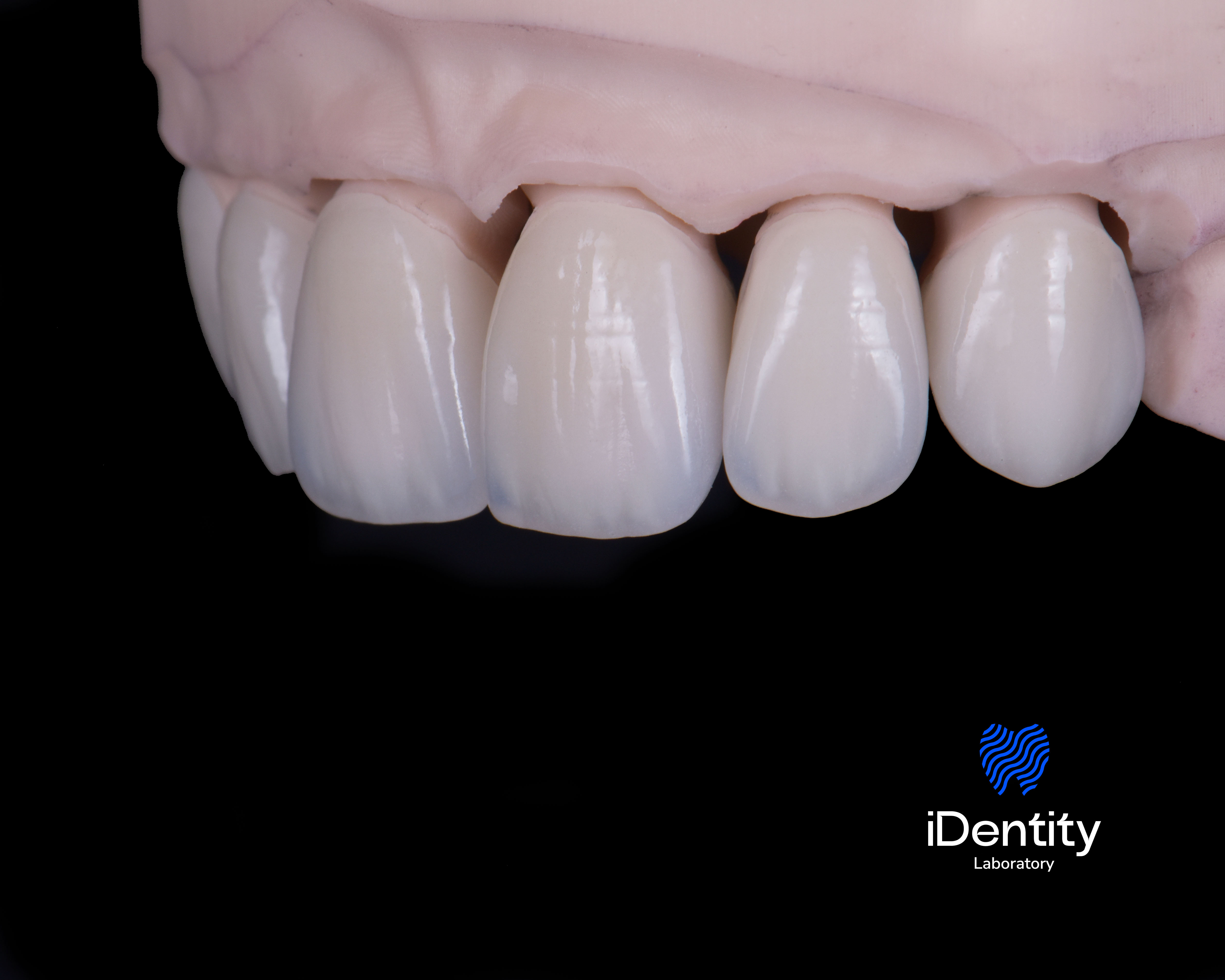Close-up of dental veneers on a model showing five front teeth against a black background.