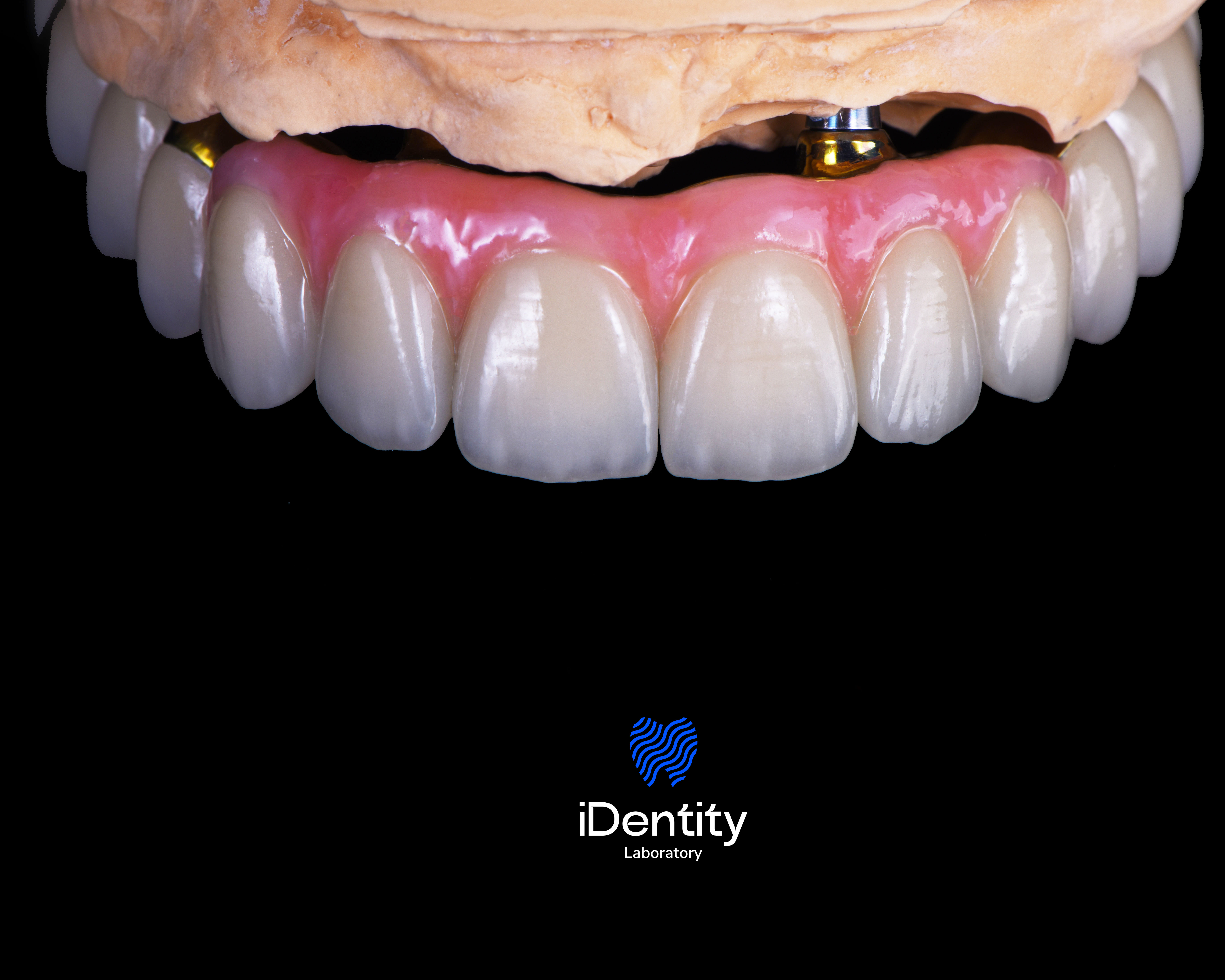 Close-up of dental prosthetic with artificial teeth and pink gum on a model base against a black background.
