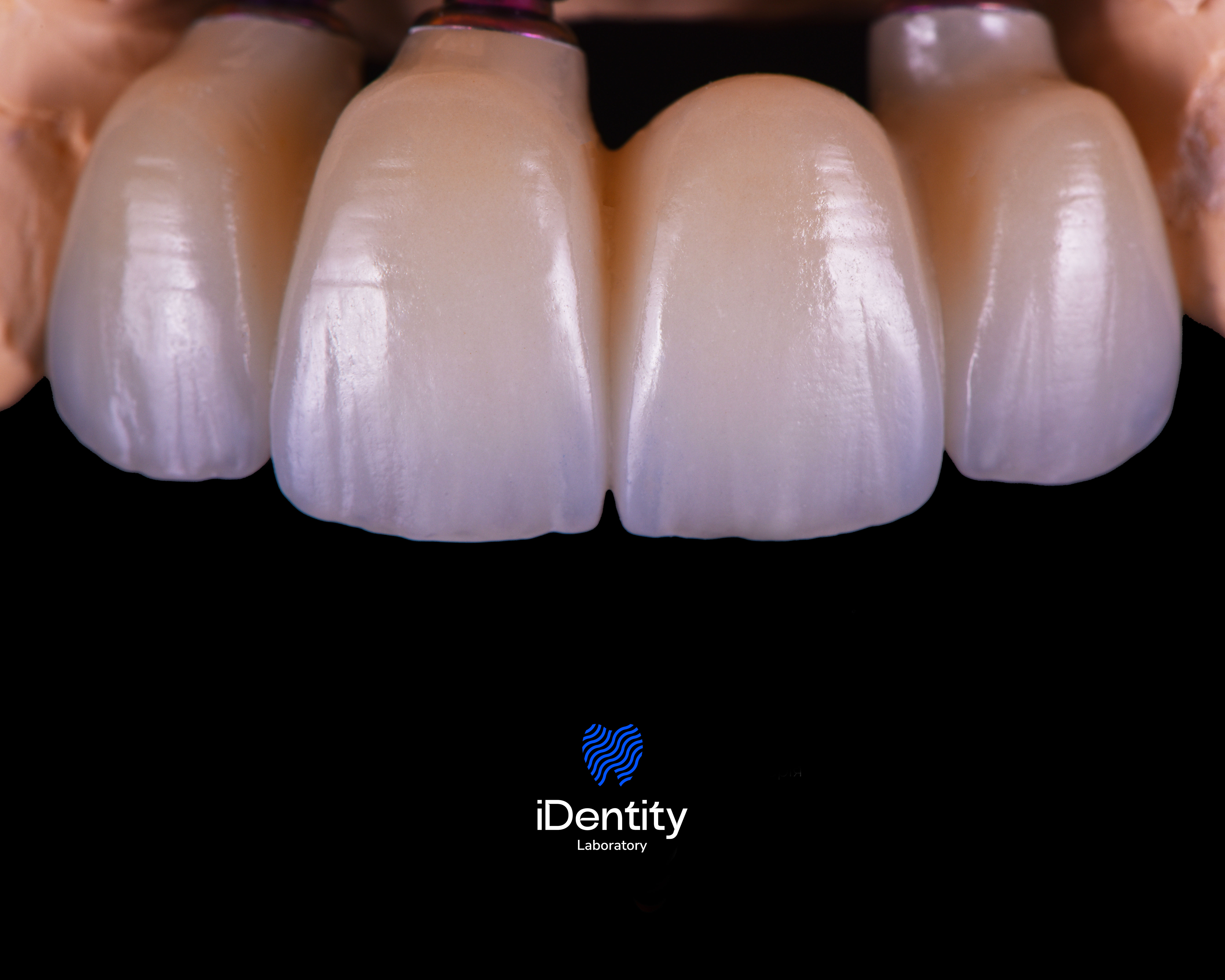 Close-up of four upper front dental crowns on a black background with iDentity Laboratory logo below.
