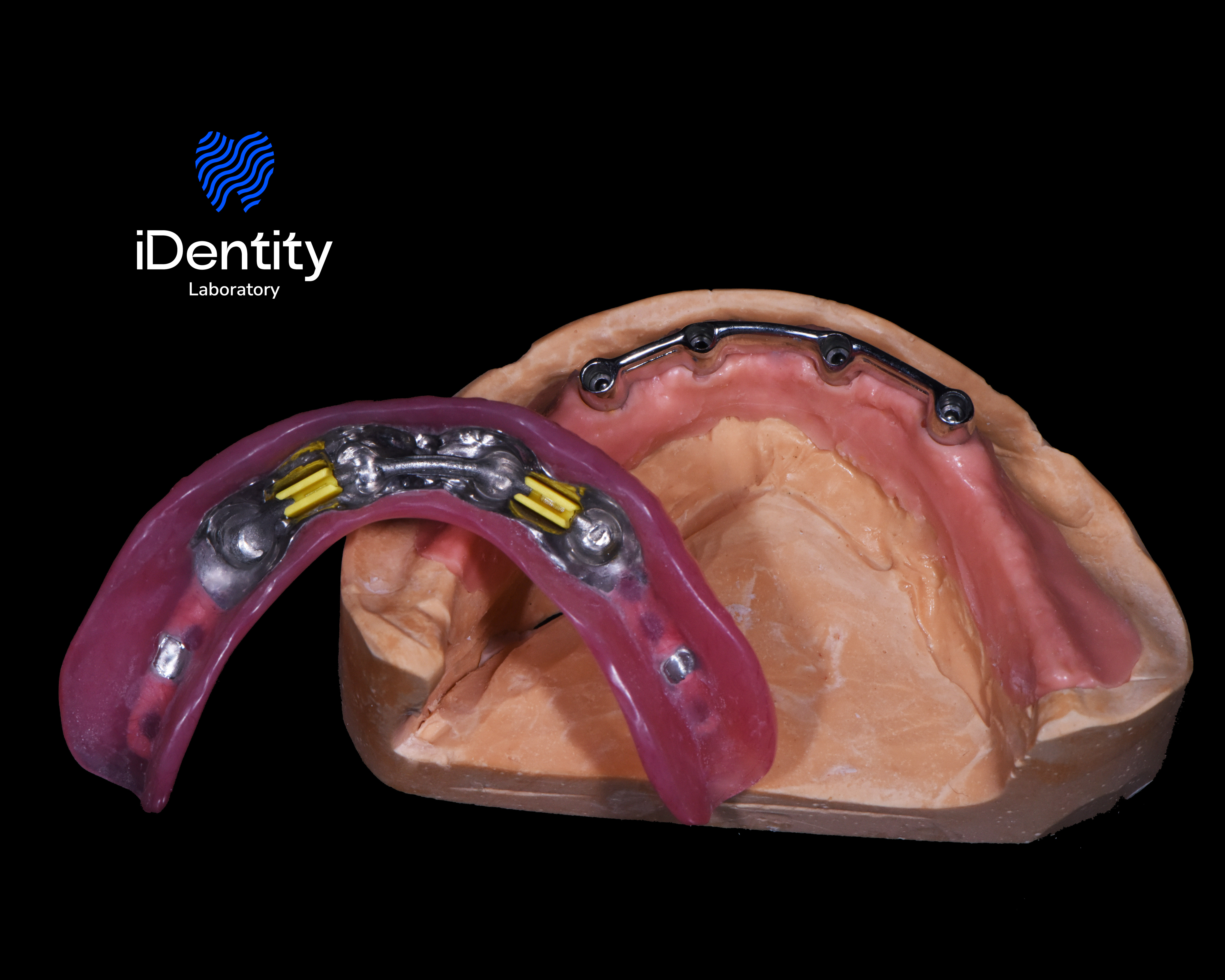 Dental implant prosthesis model showing an upper jaw with metal framework attachments and a removable denture with metal and yellow components.