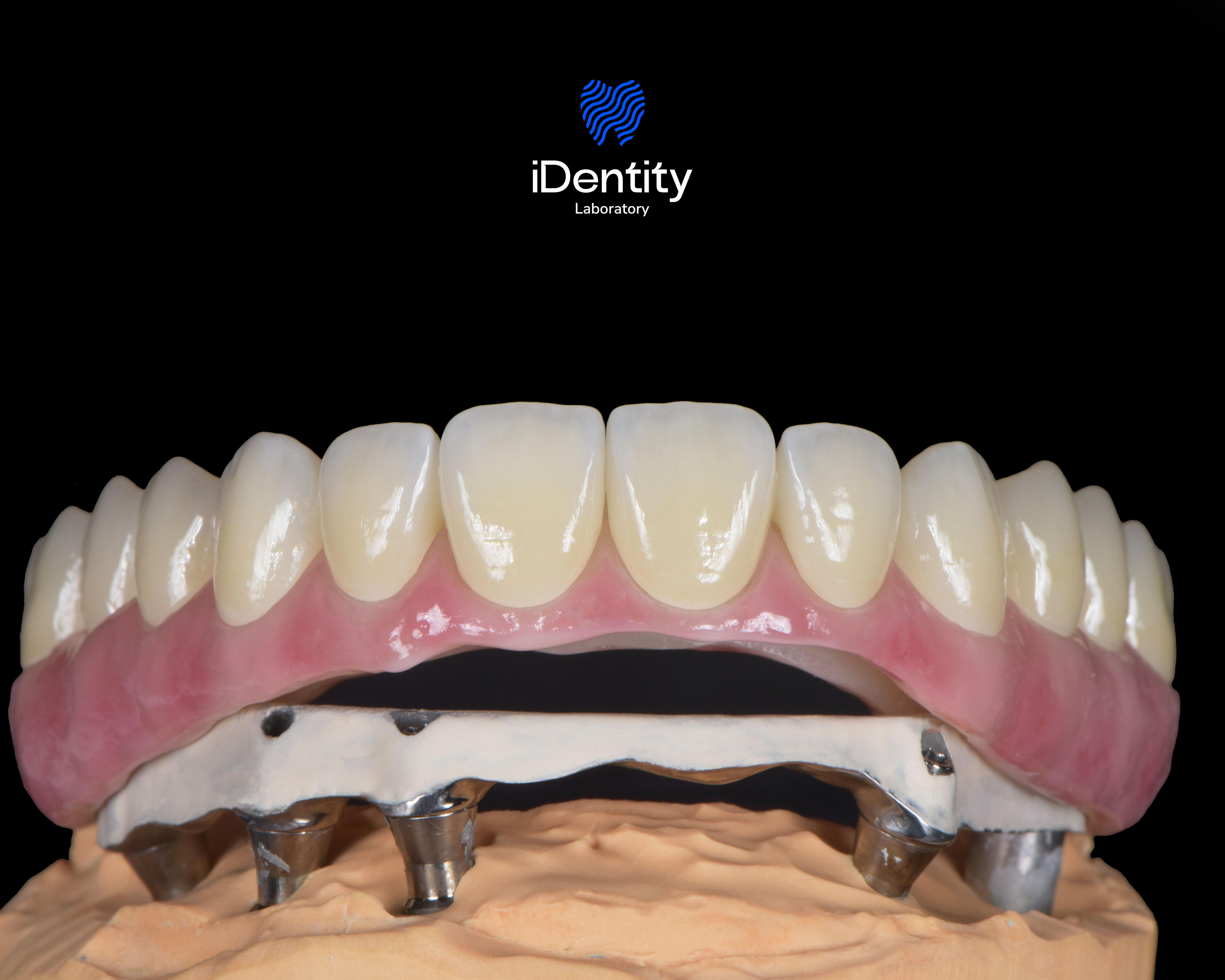 Full set of upper dental prosthesis mounted on metal implants on a dental model with pink gums and white teeth.