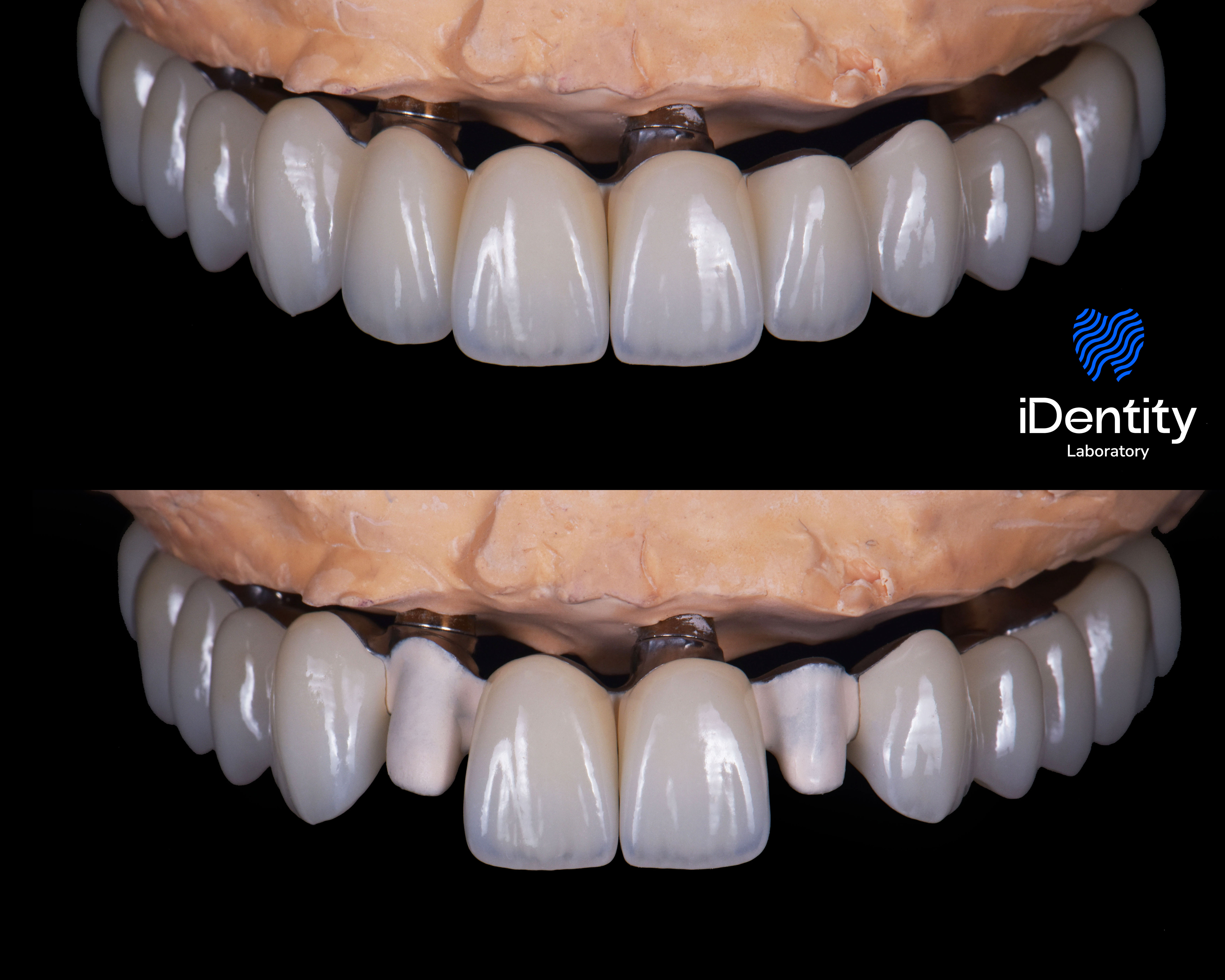 Close-up of dental prosthetics on a model showing full upper teeth with implants in place, with and without dental crowns.
