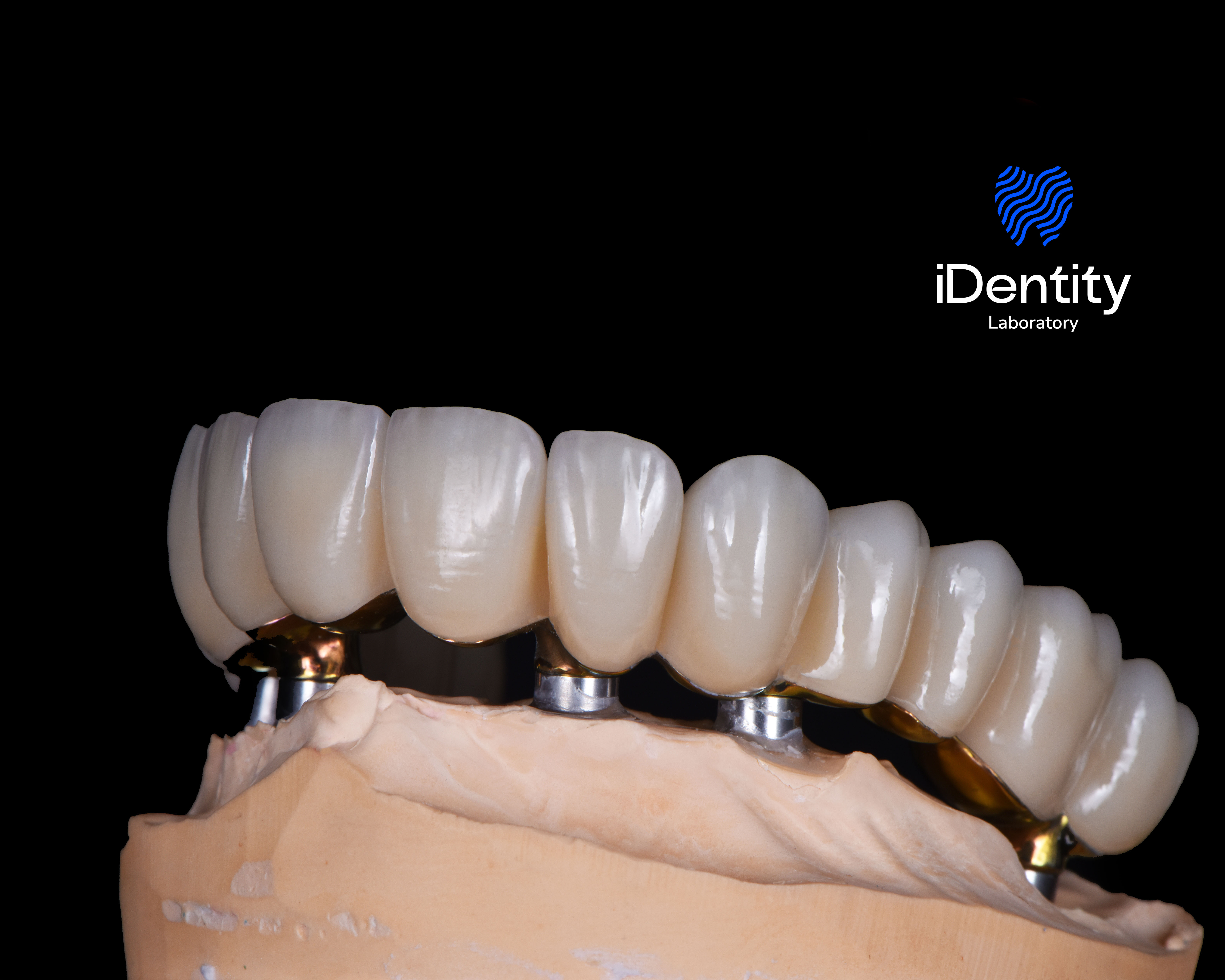 Close-up of a dental prosthesis with ceramic crowns mounted on a dental model against a black background.