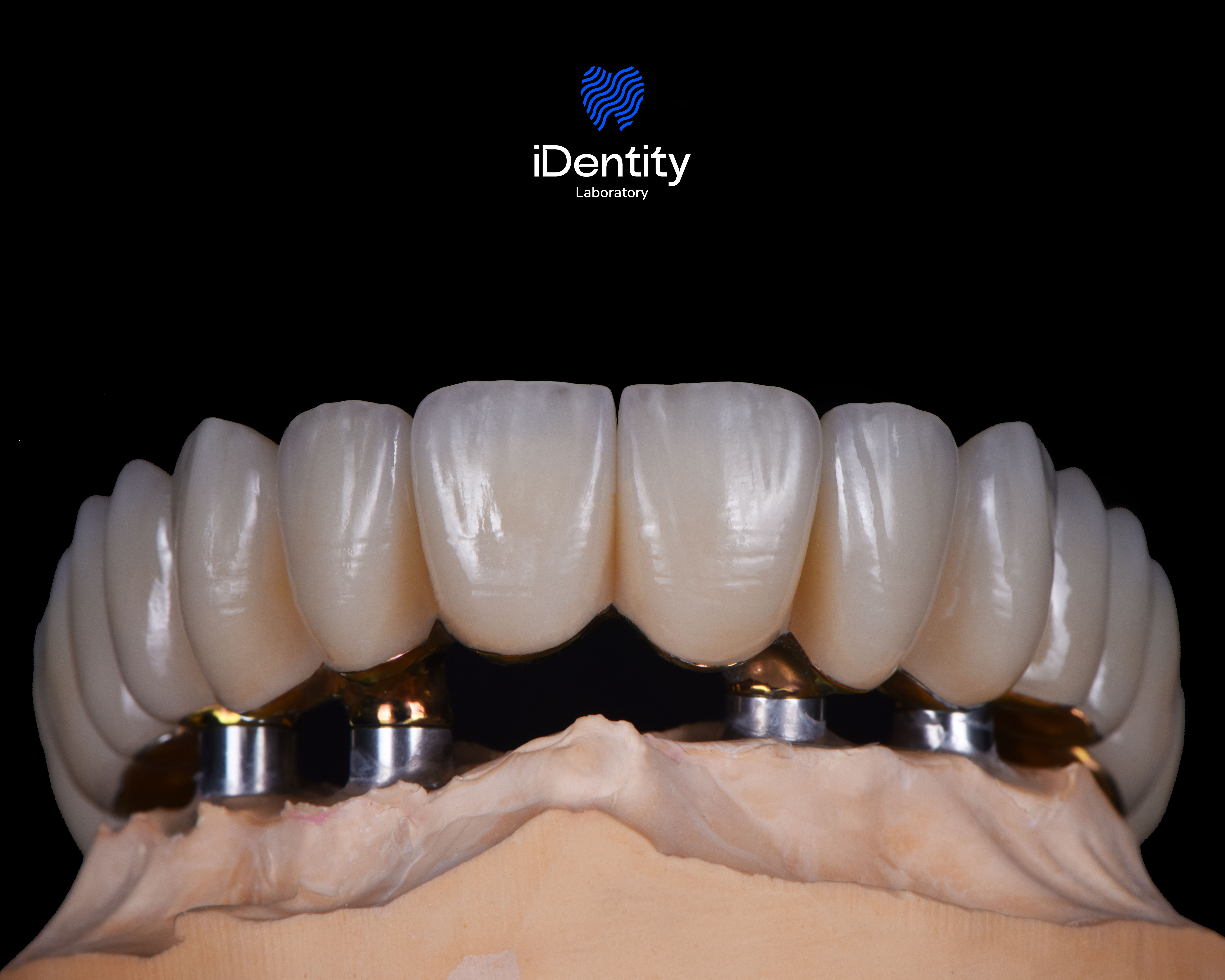 Close-up of dental prosthetic teeth set on a plaster mold with metal abutments against a black background.