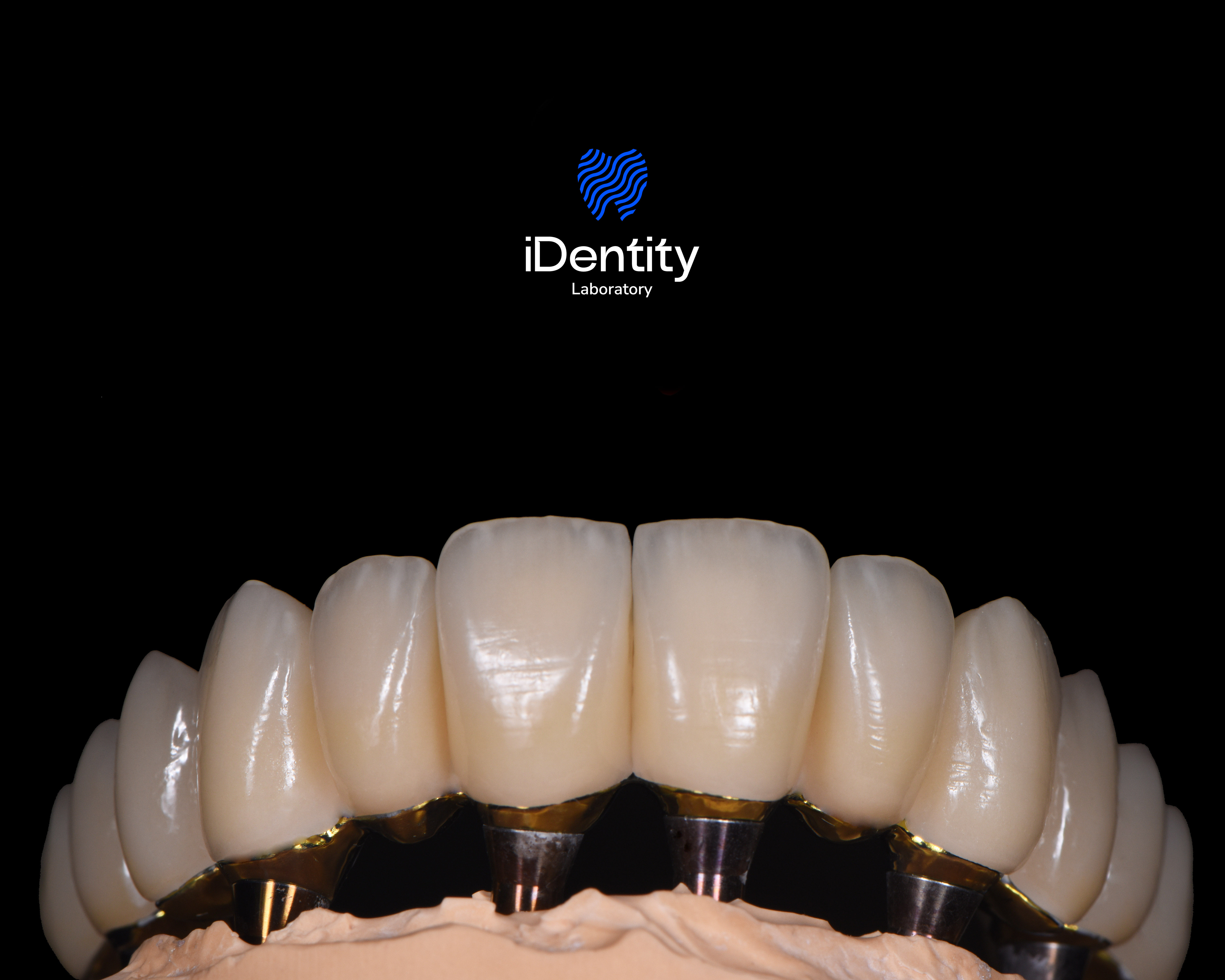 Close-up of dental prosthetic with porcelain teeth mounted on metal abutments against a black background with iDentity Laboratory logo above.