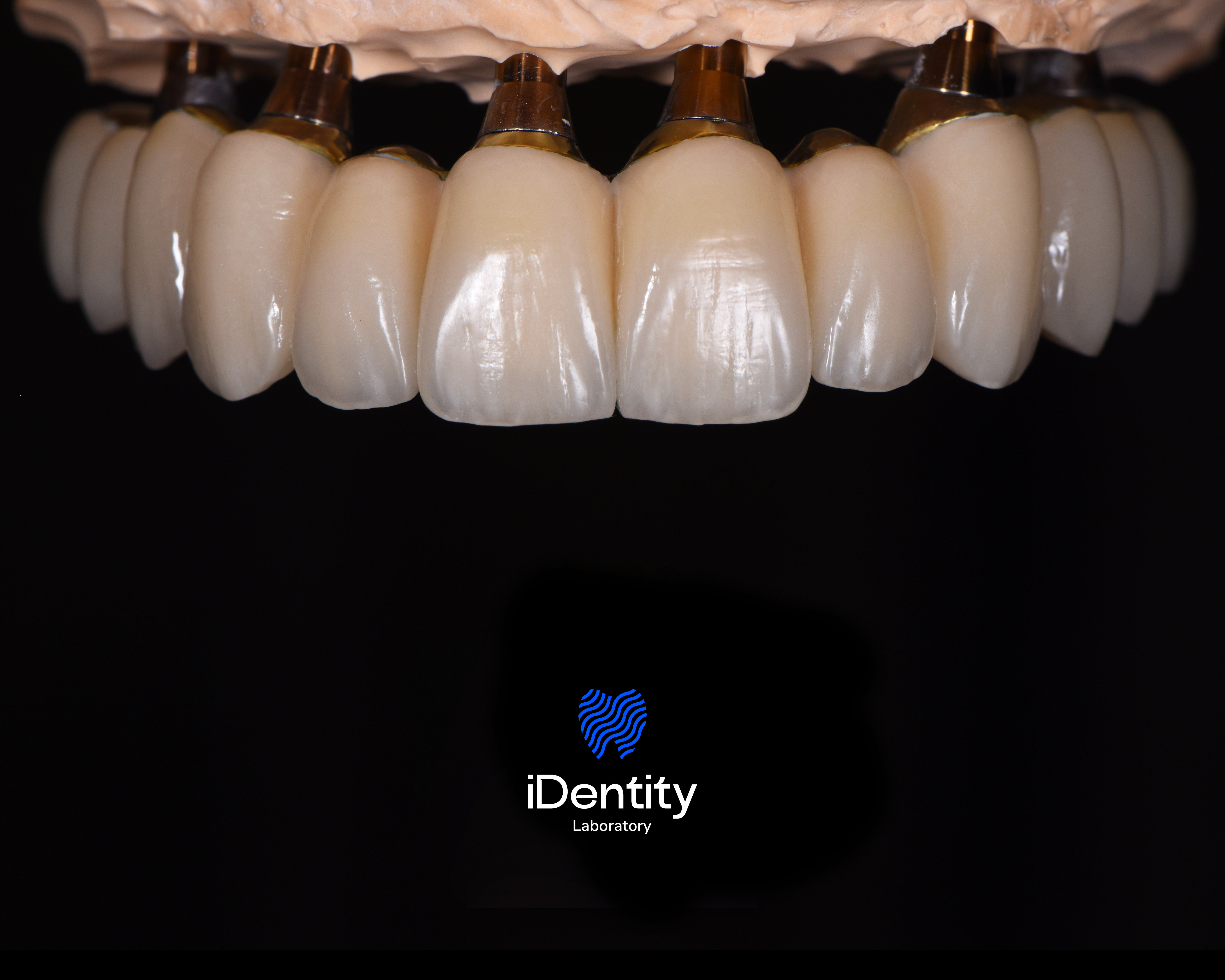 Close-up of dental prosthetic teeth attached to metal implants on a black background.