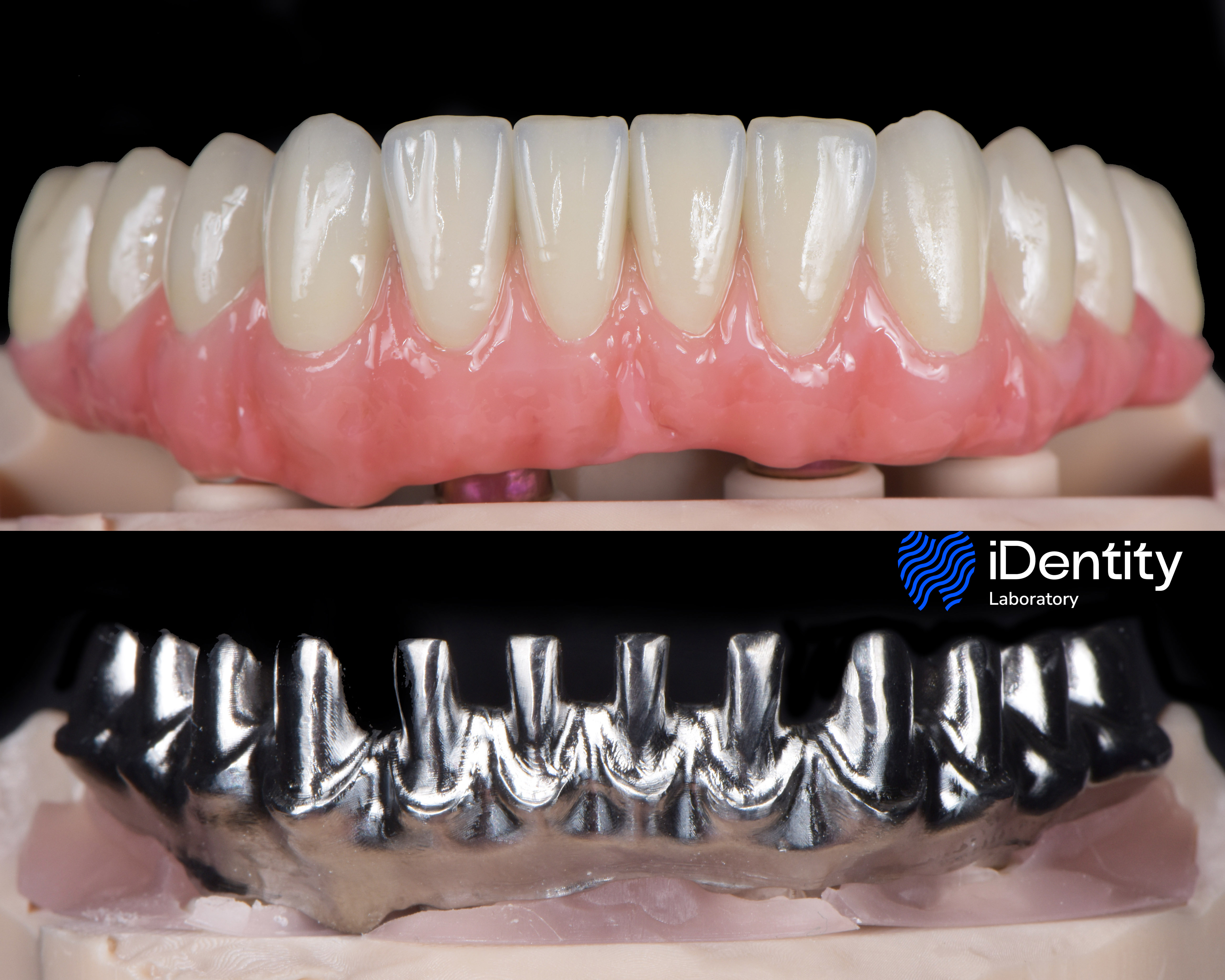 Close-up of dental prosthetic with artificial teeth and gums on top, and a metal framework below.
