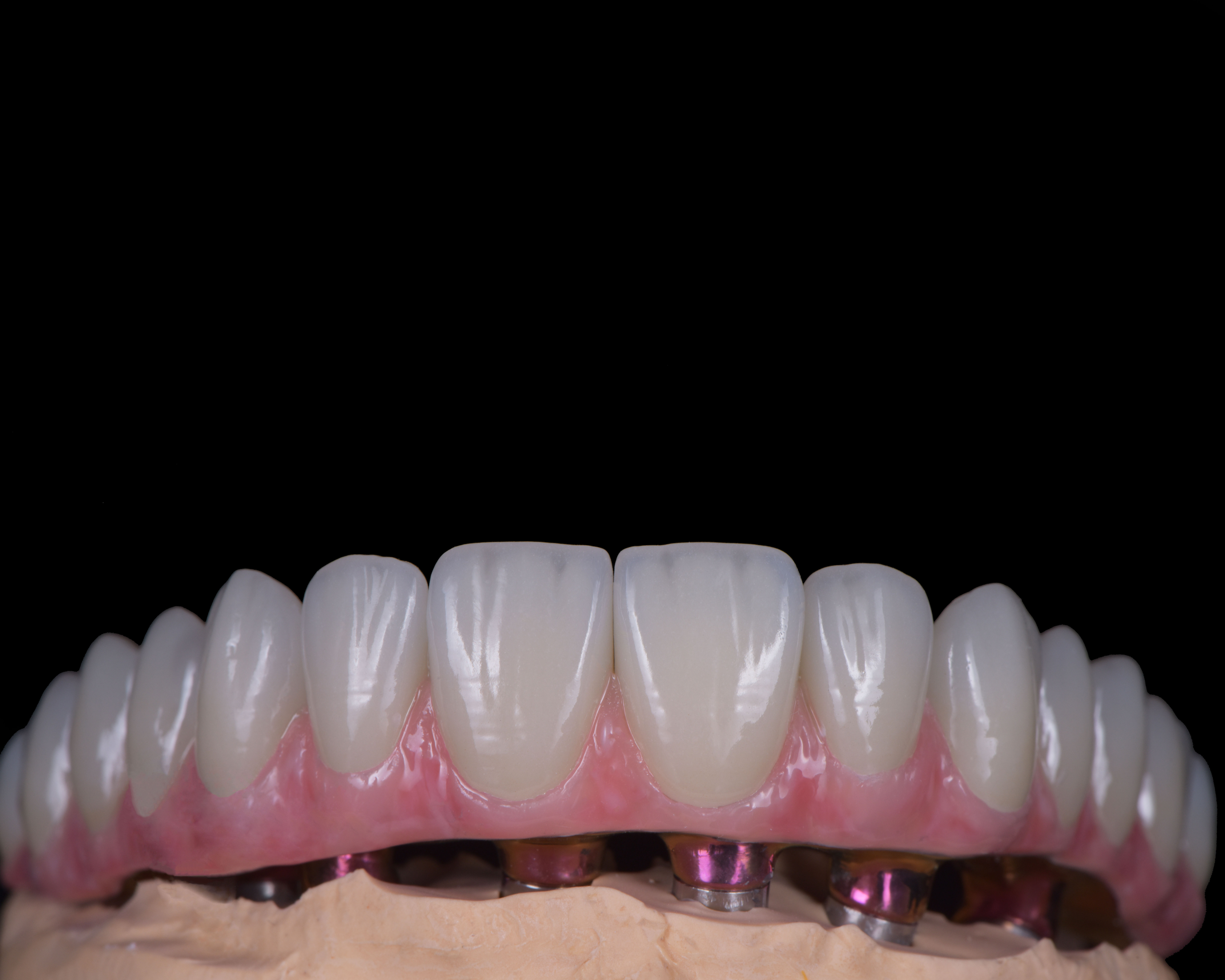 Close-up of a dental prosthesis with artificial teeth attached to implants on a model base against a black background.