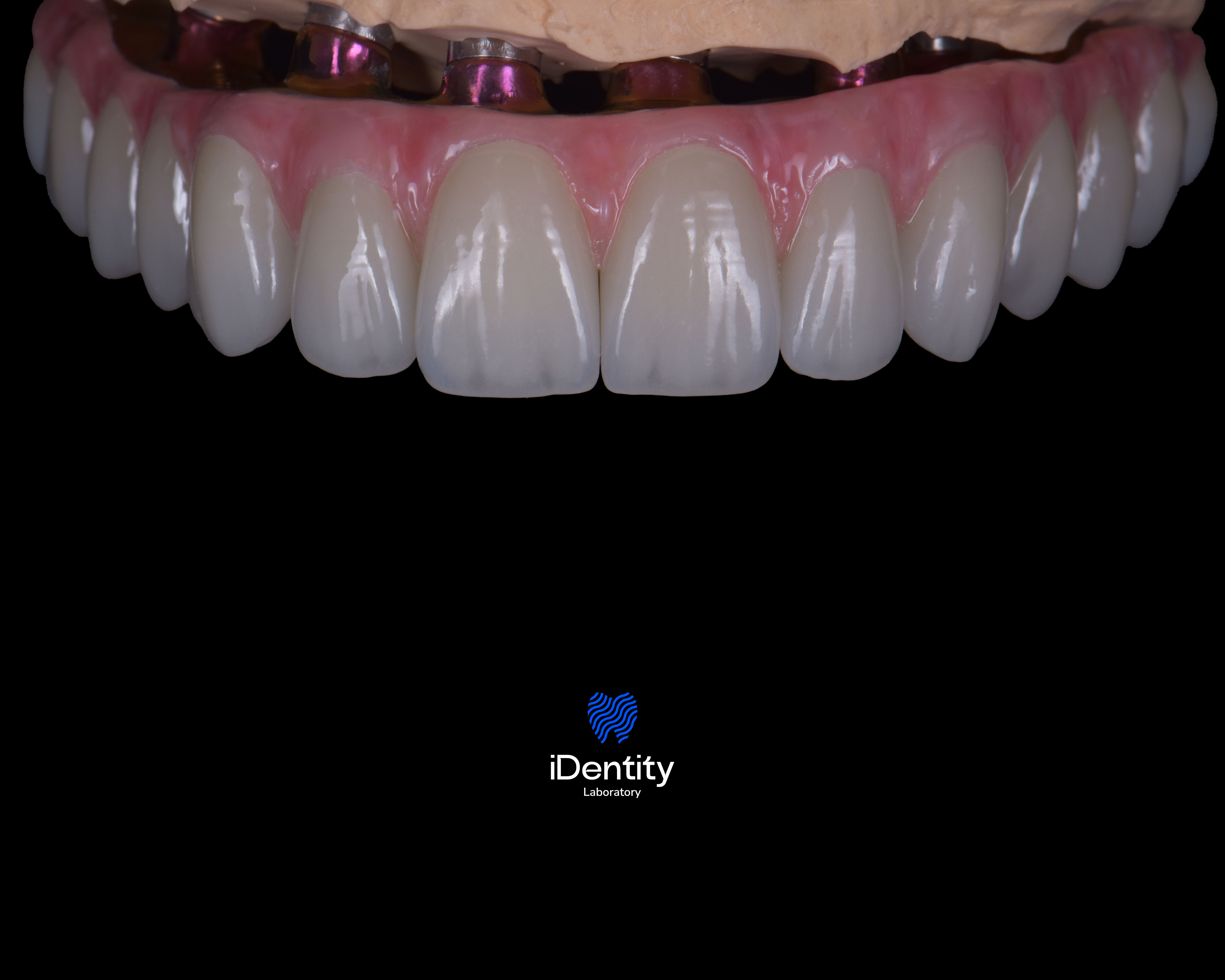 Close-up of dental prosthetic with ceramic teeth and pink gum material on a black background.