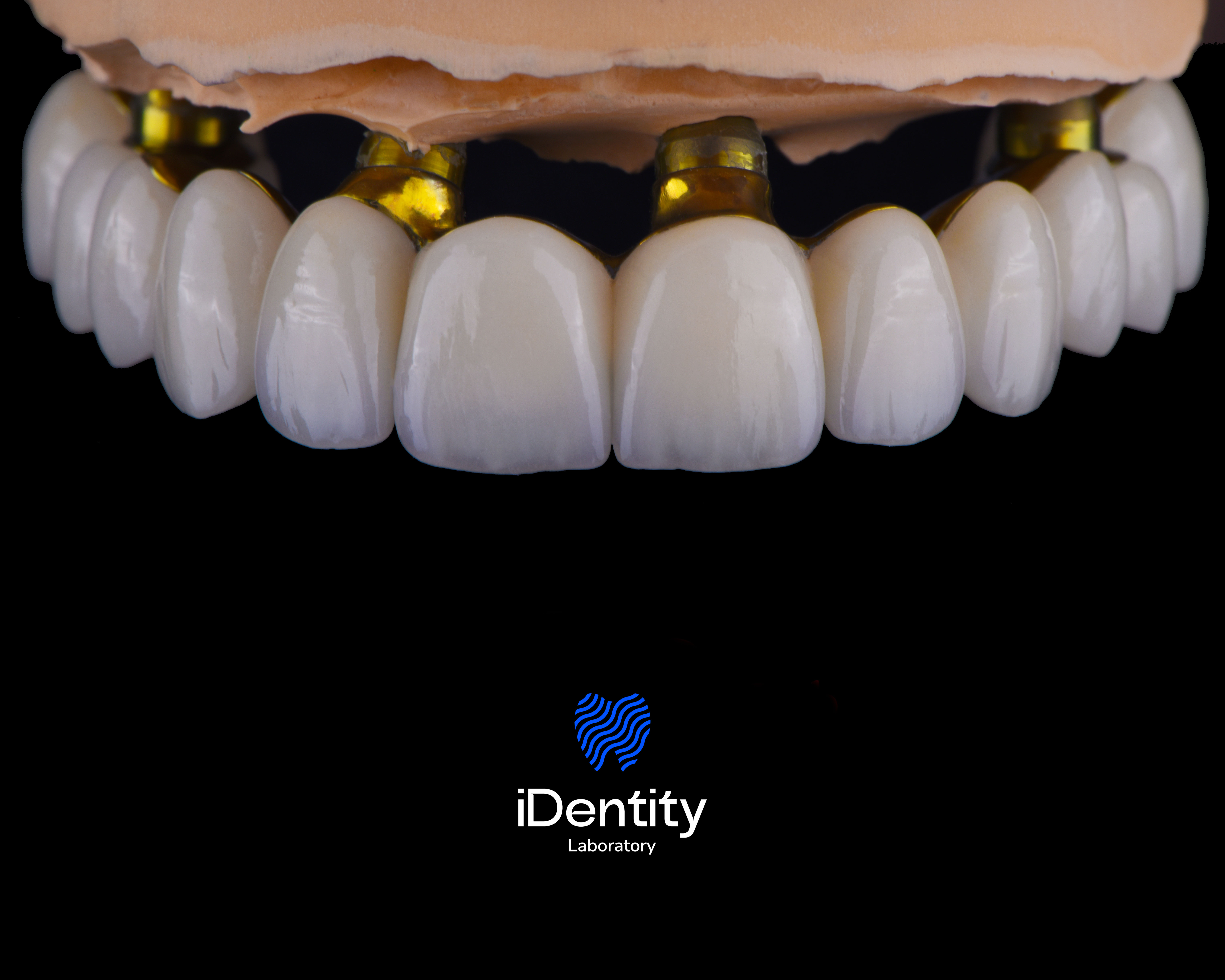 Dental prosthetic model with a set of white artificial teeth mounted on golden implants.