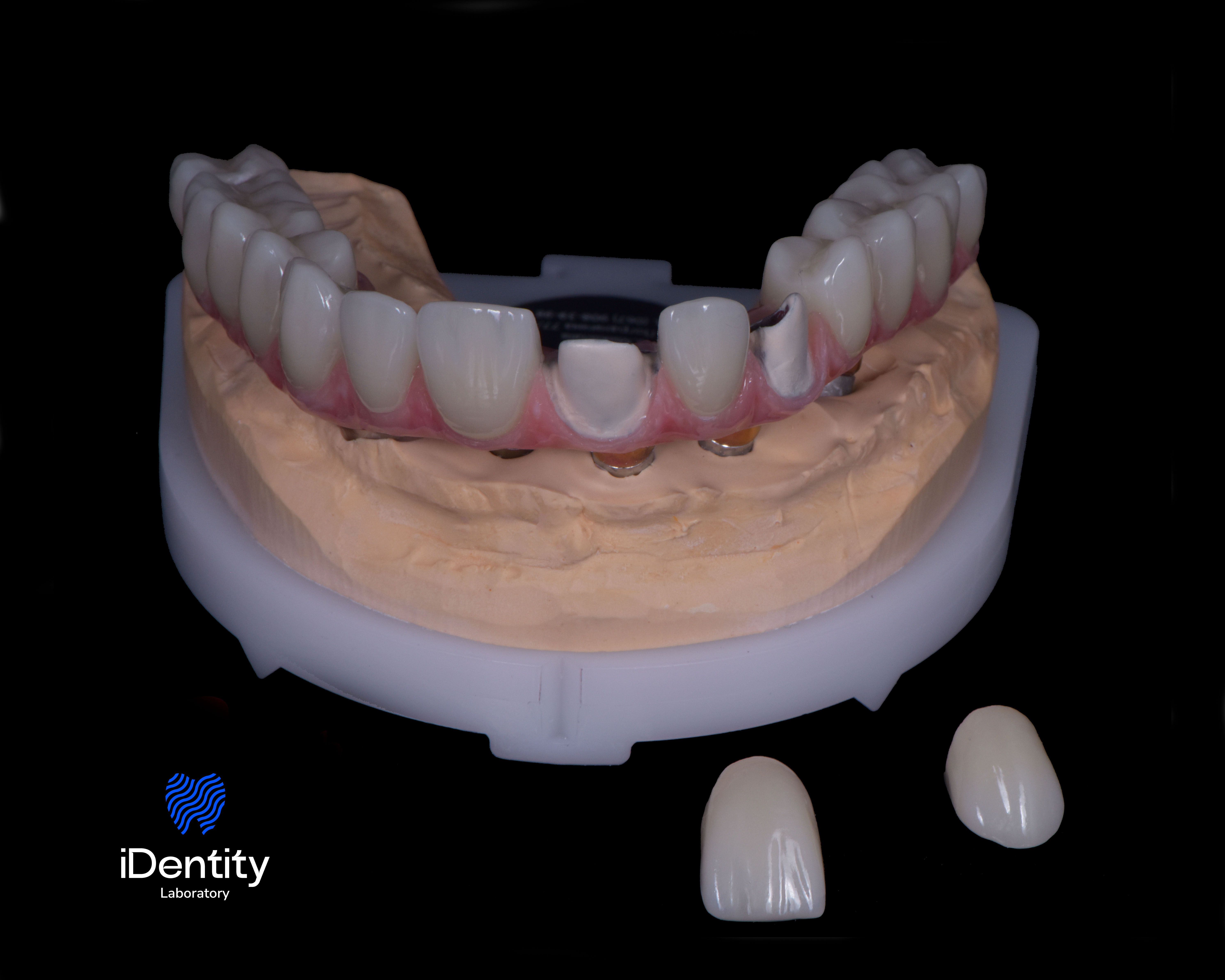 Dental prosthetic model with artificial teeth on a beige base and two detached front tooth crowns on a black background.
