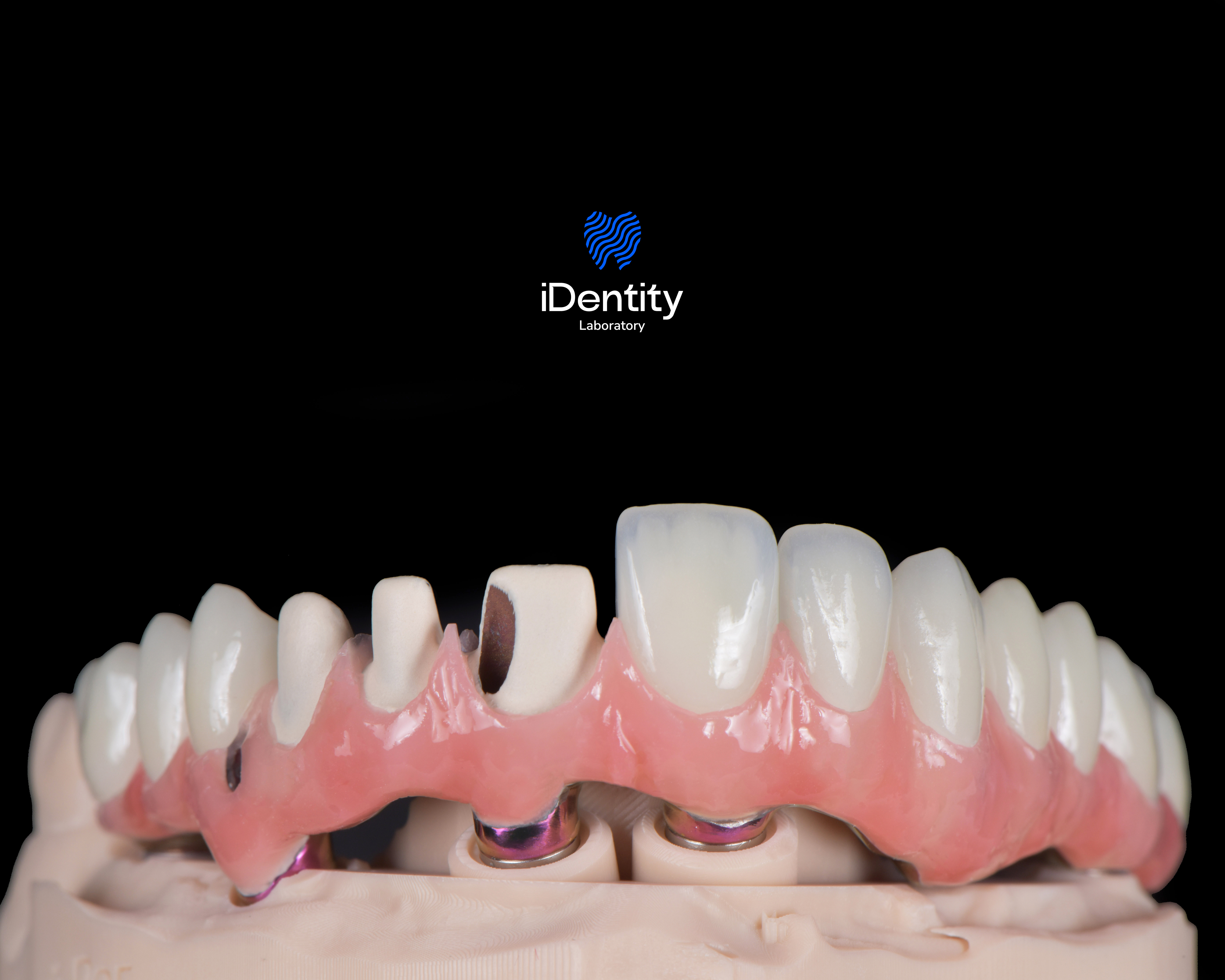 Dental model showing a set of artificial teeth with dental implants and crowns on a black background.