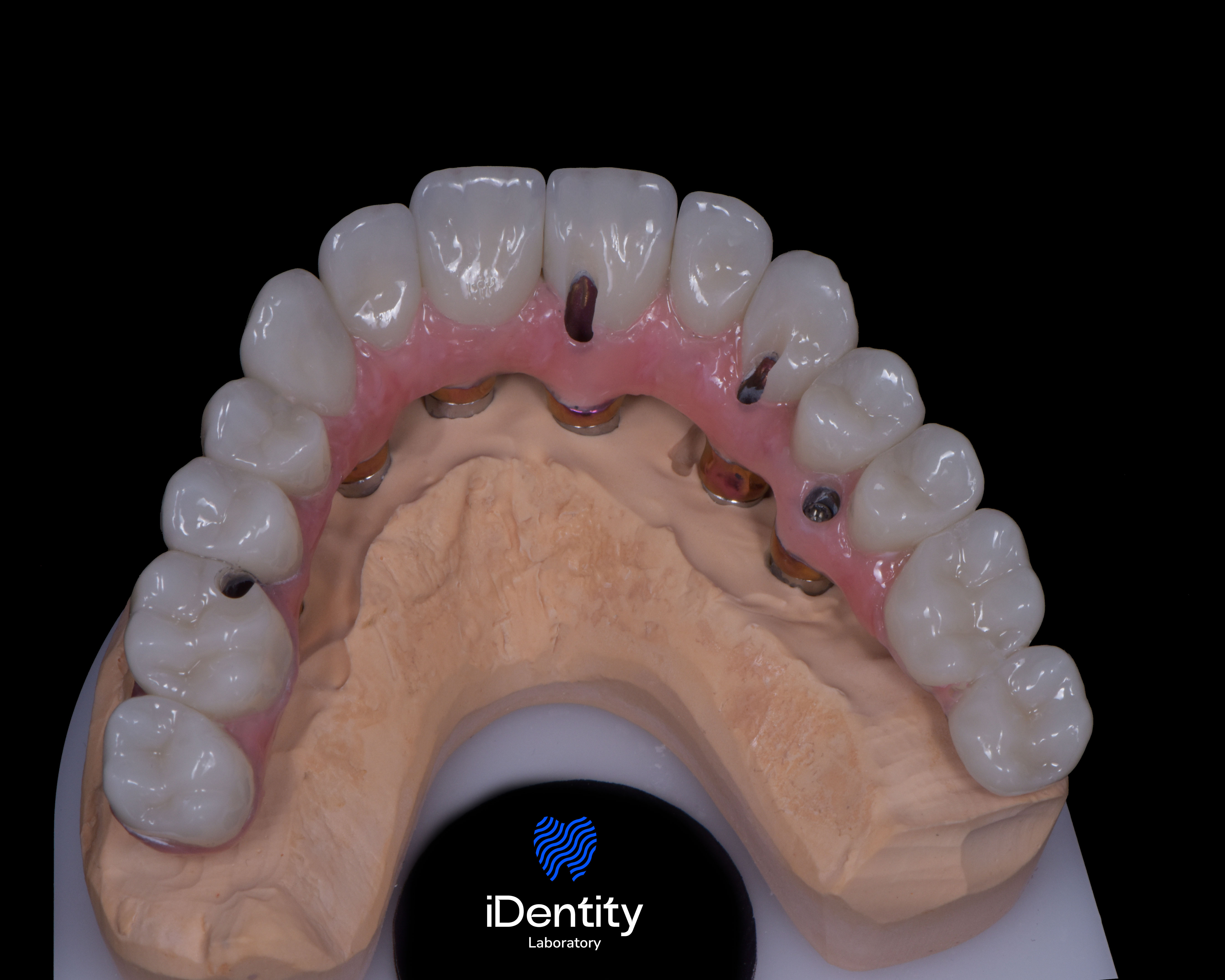 Dental prosthetic model showing an upper arch with artificial teeth and pink gum material on a beige dental mold.
