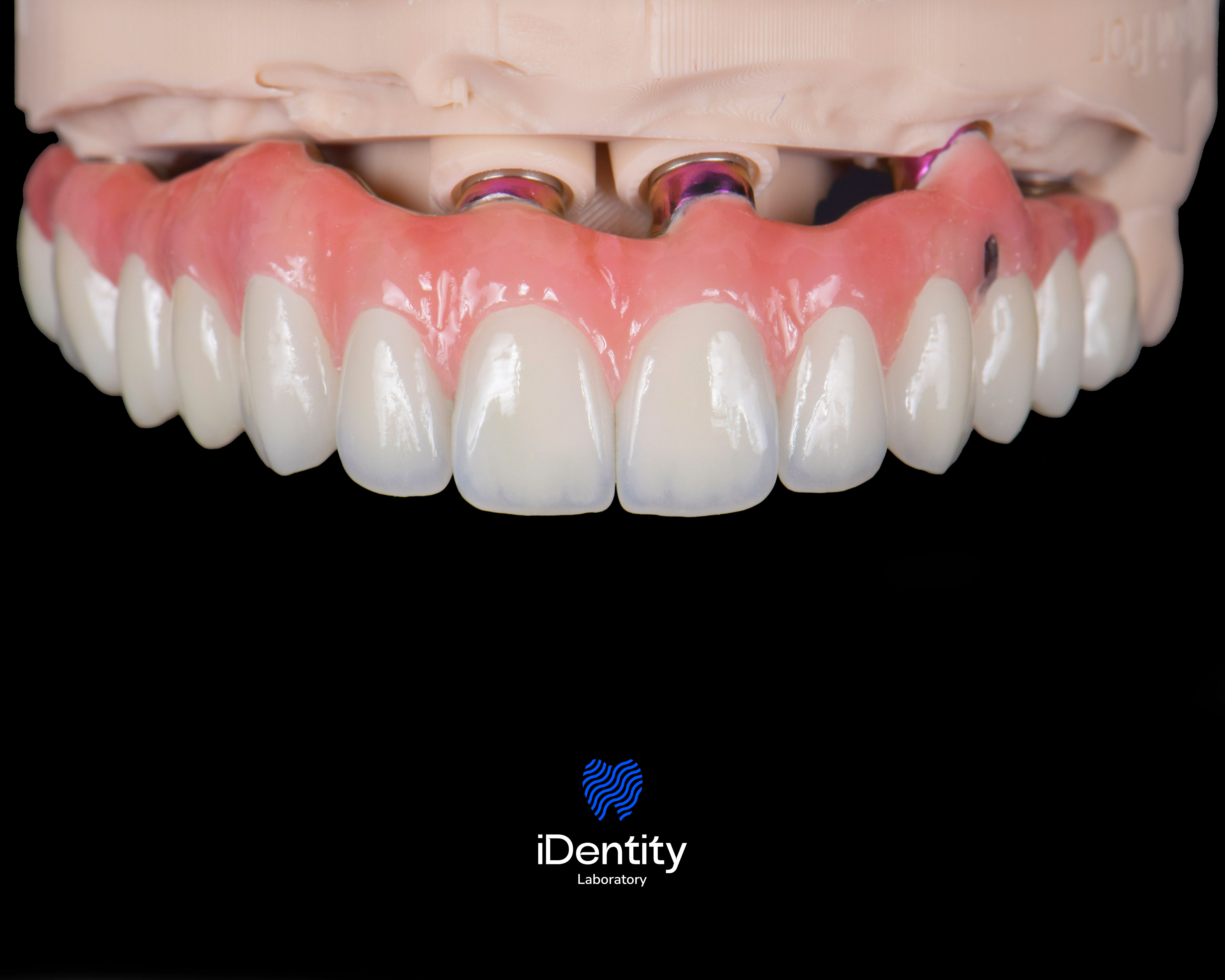 Close-up of a dental prosthesis with white teeth and pink gums on a model stand.
