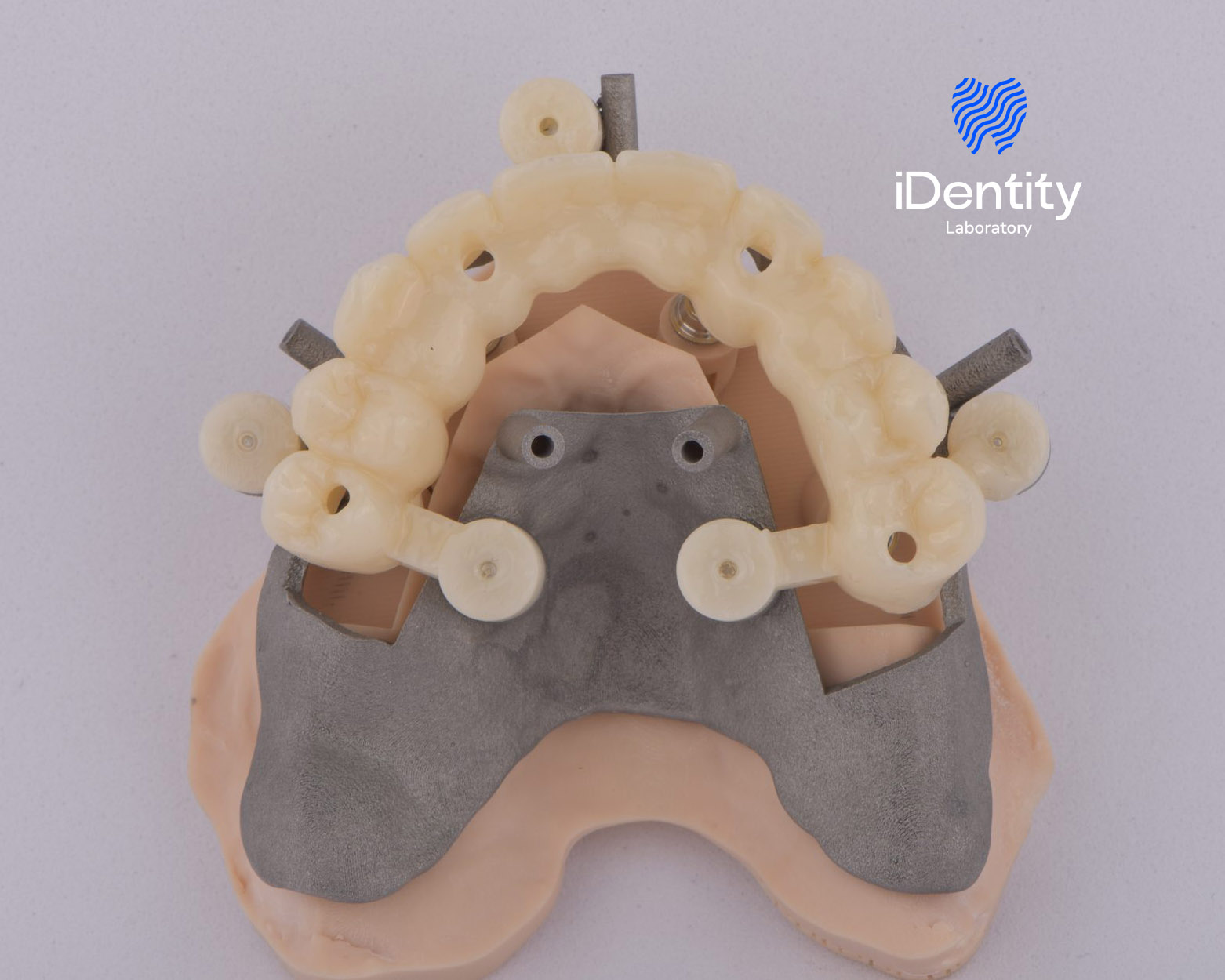 Dental model showing a partial upper jaw with a metal framework and attached prosthetic teeth.