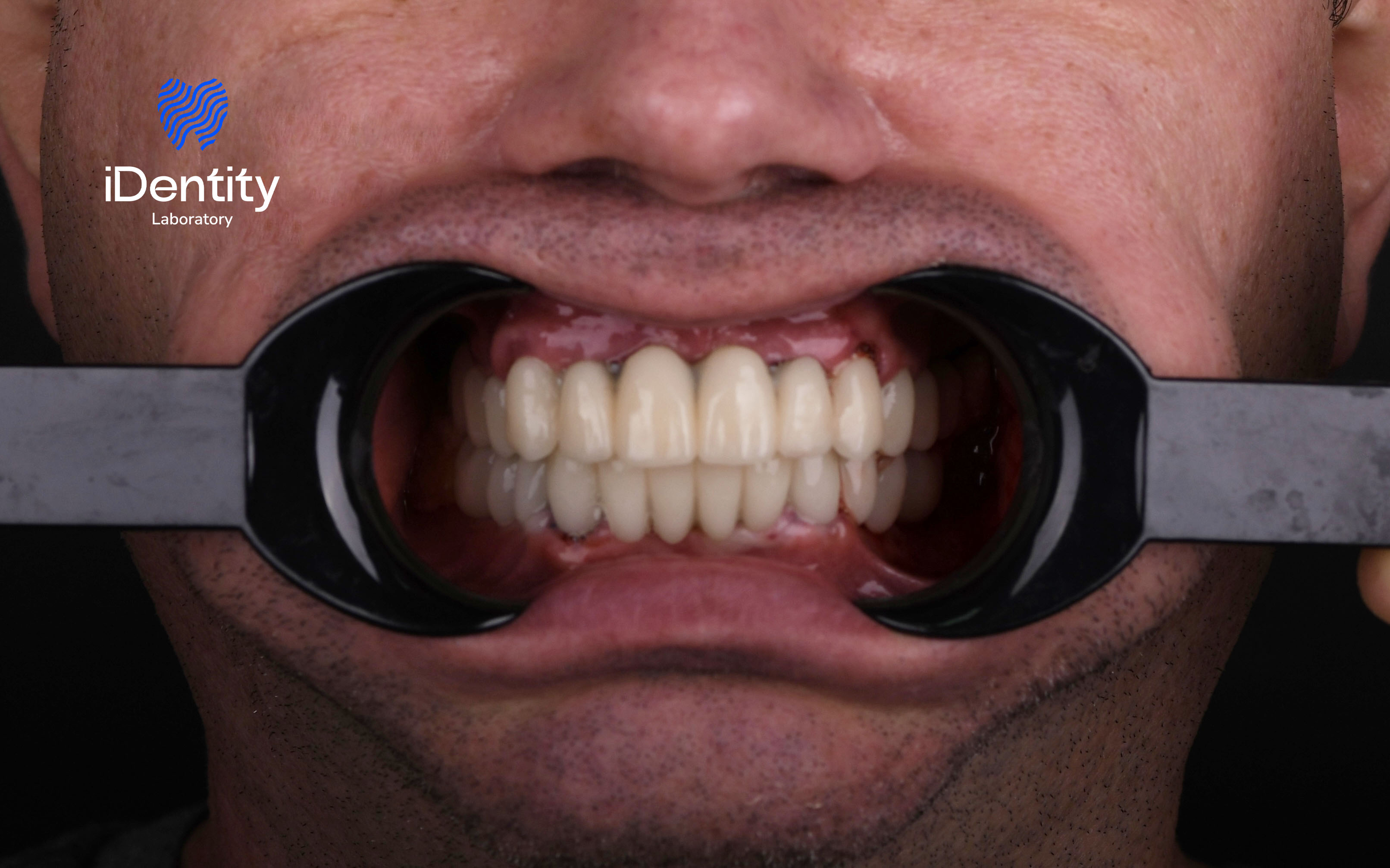 Close-up of a man’s mouth with dental cheek retractors showing natural-looking dental prosthetic teeth.