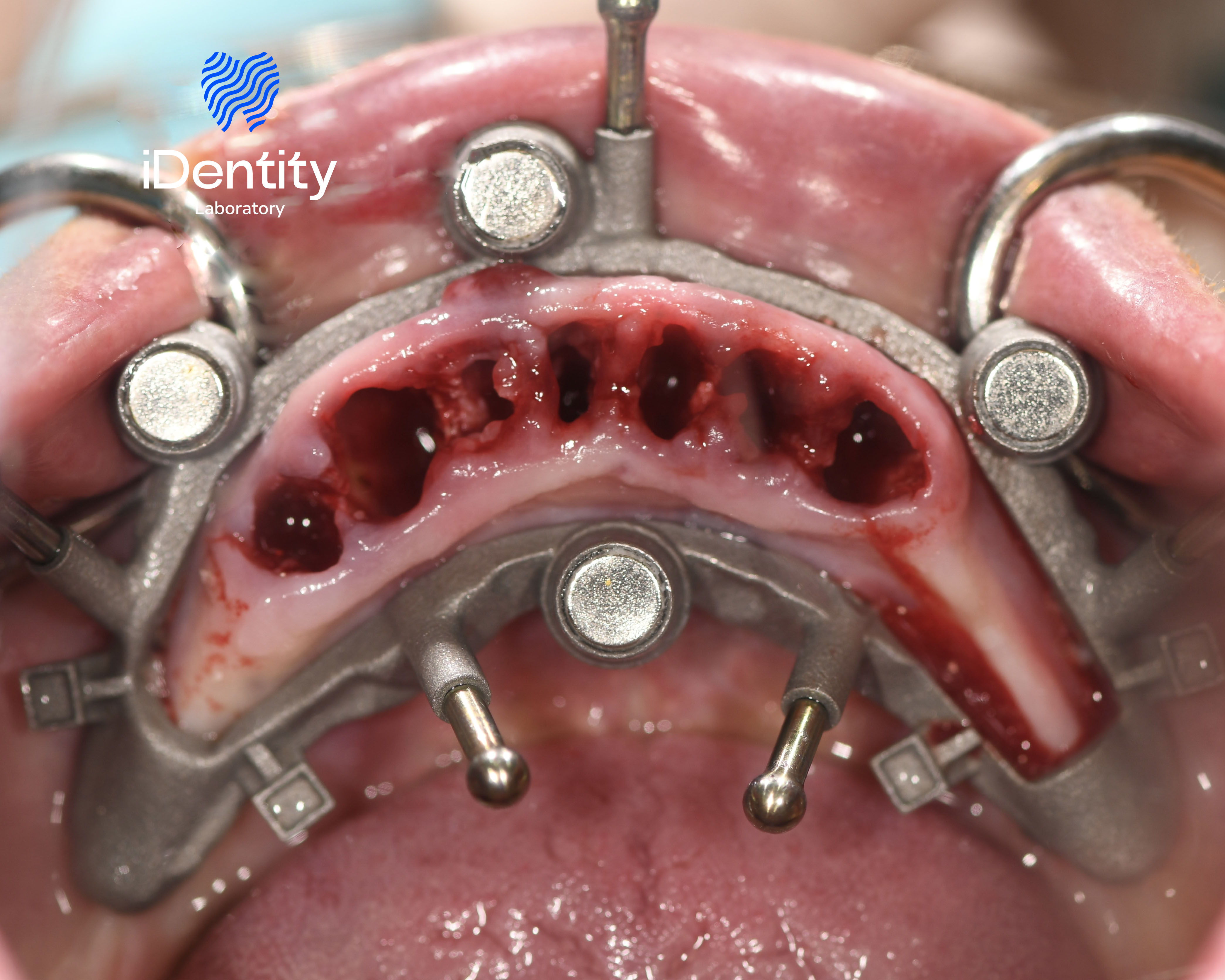 Close-up of a patient's upper jaw with multiple dental implant sites and a metal surgical guide in place.