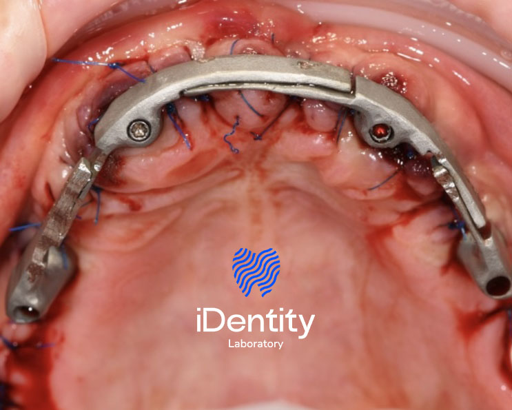 Close-up of an upper jaw with dental implant surgery showing a metal implant bar fixed with blue sutures on the gums.