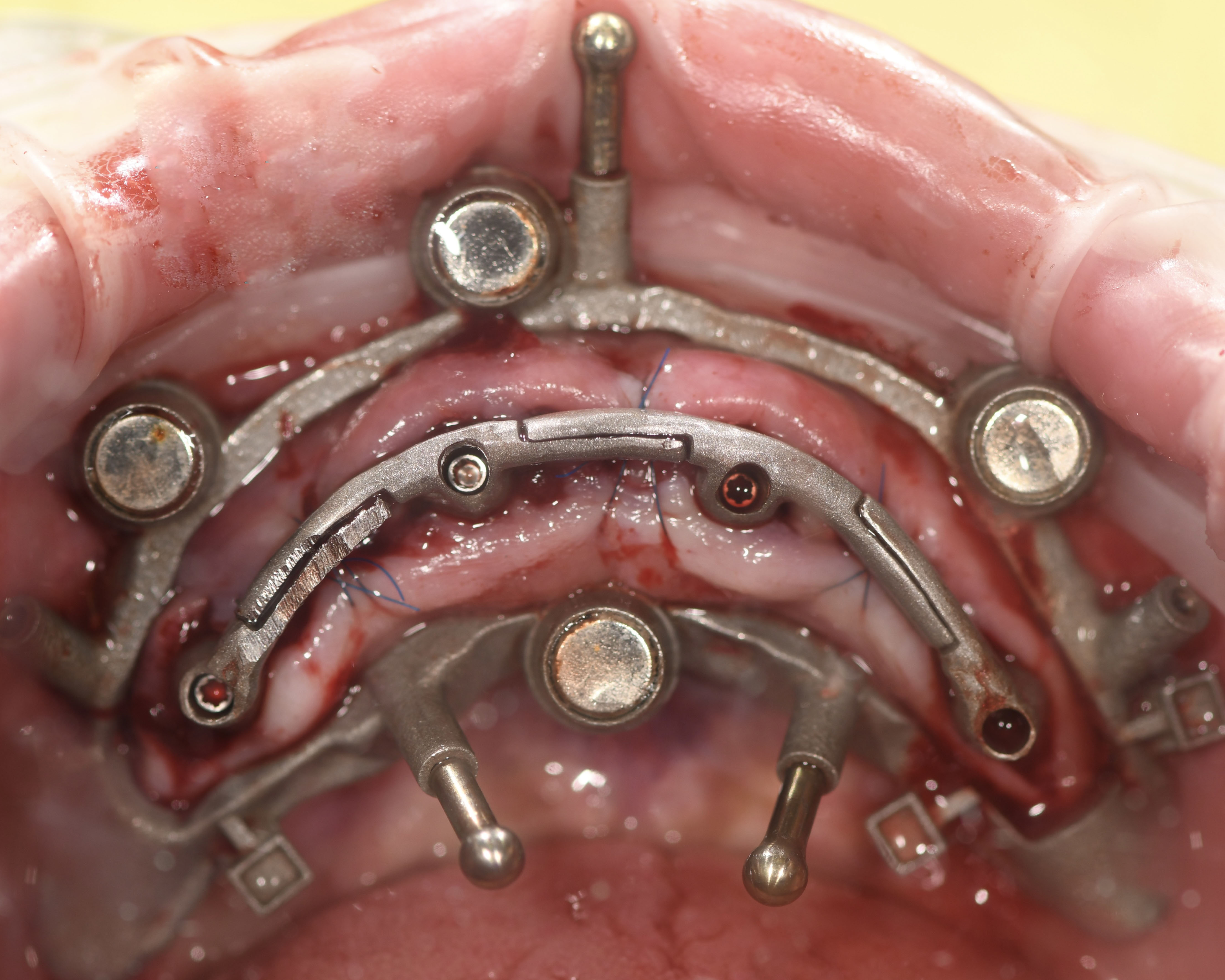 Close-up of a dental surgical guide fixed in the upper jaw with metal implants and sutures visible.