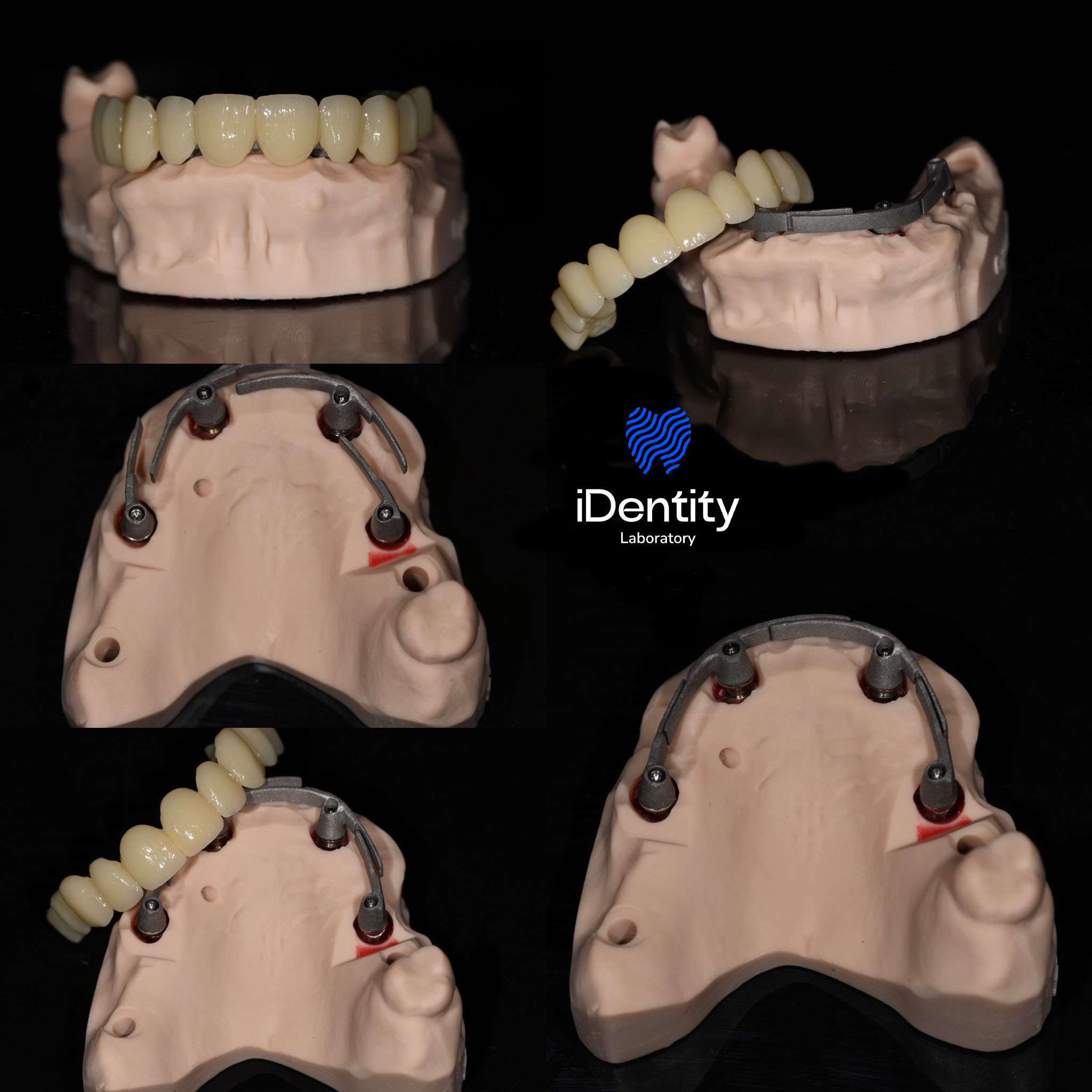 Collage showing dental prosthetic model with artificial teeth and metal framework from multiple angles on a black background.