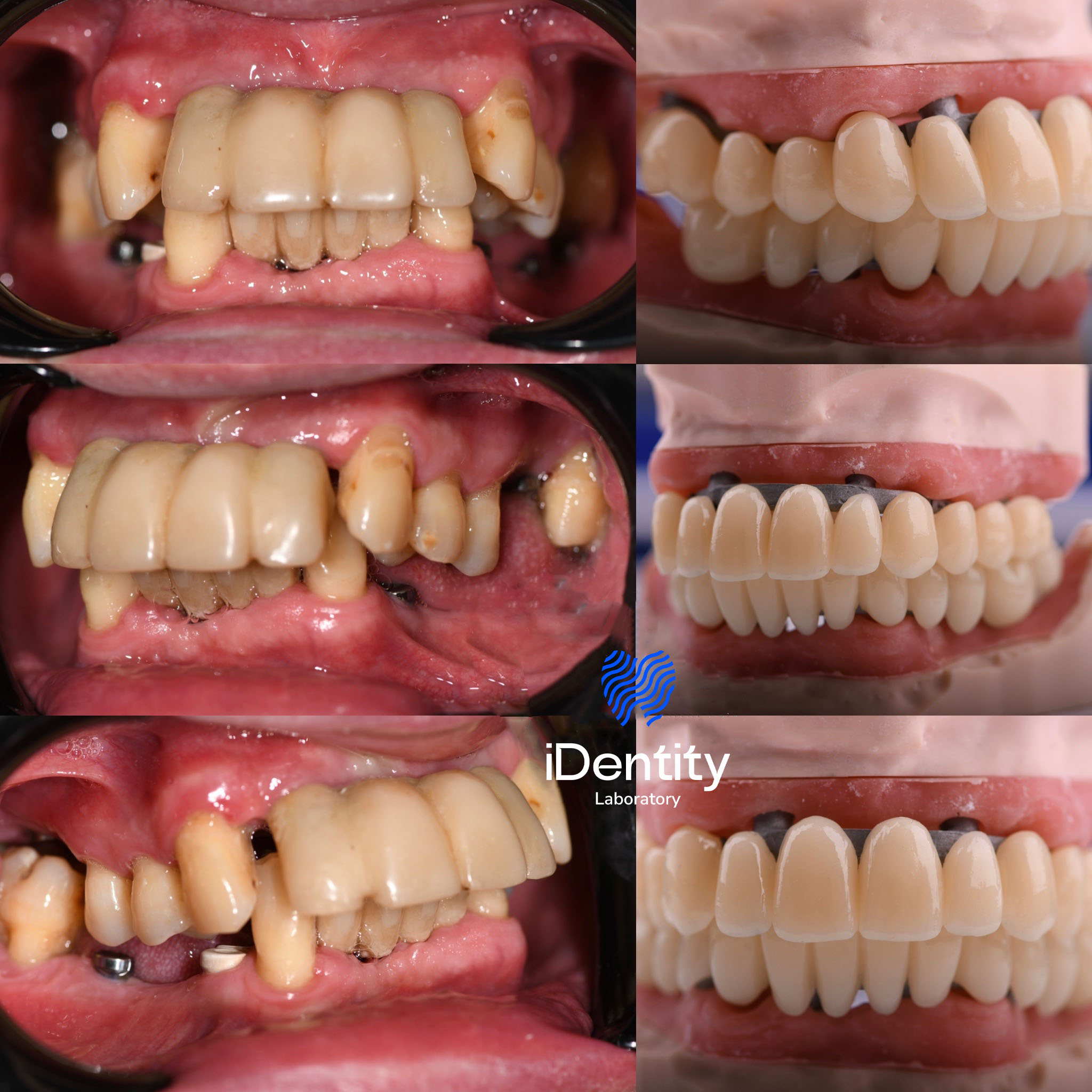 Collage of close-up images showing dental restoration with natural teeth on left and matching dental prosthetics on right.