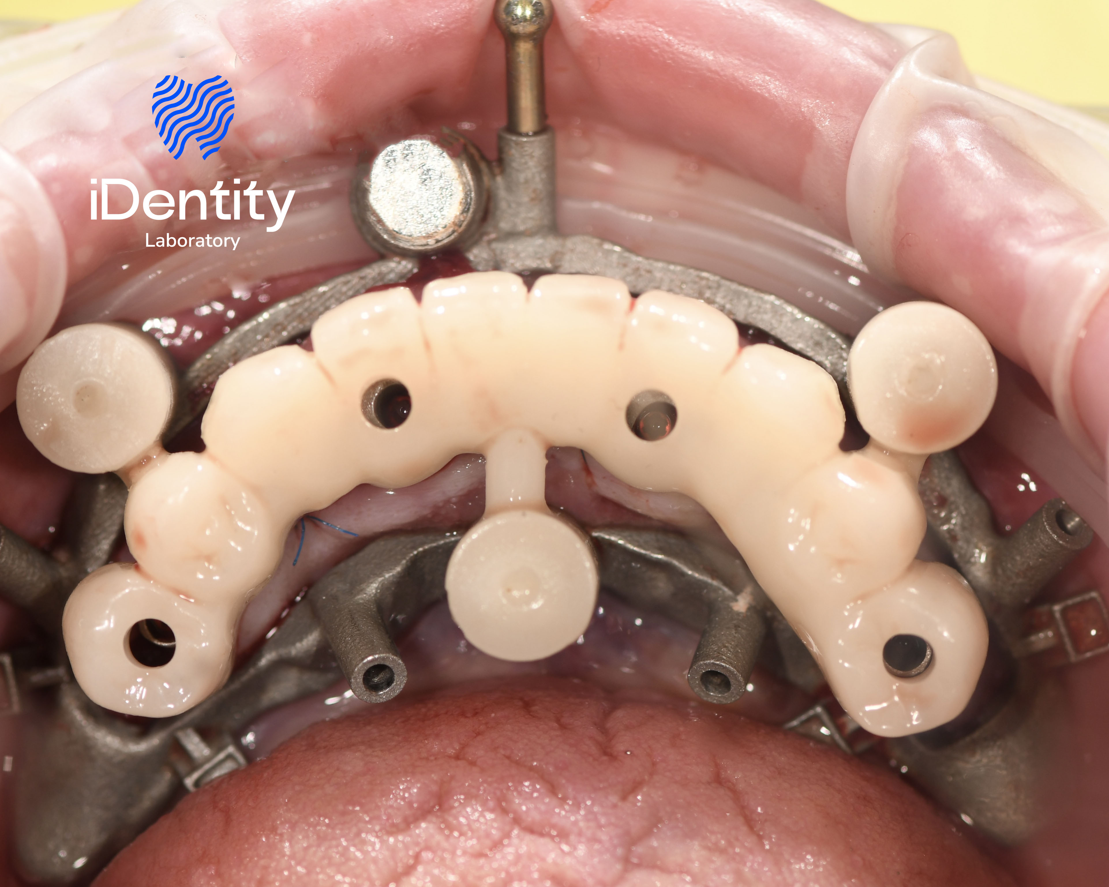 Close-up of a dental implant guide positioned in the upper jaw with metal abutments and surrounding gums visible.