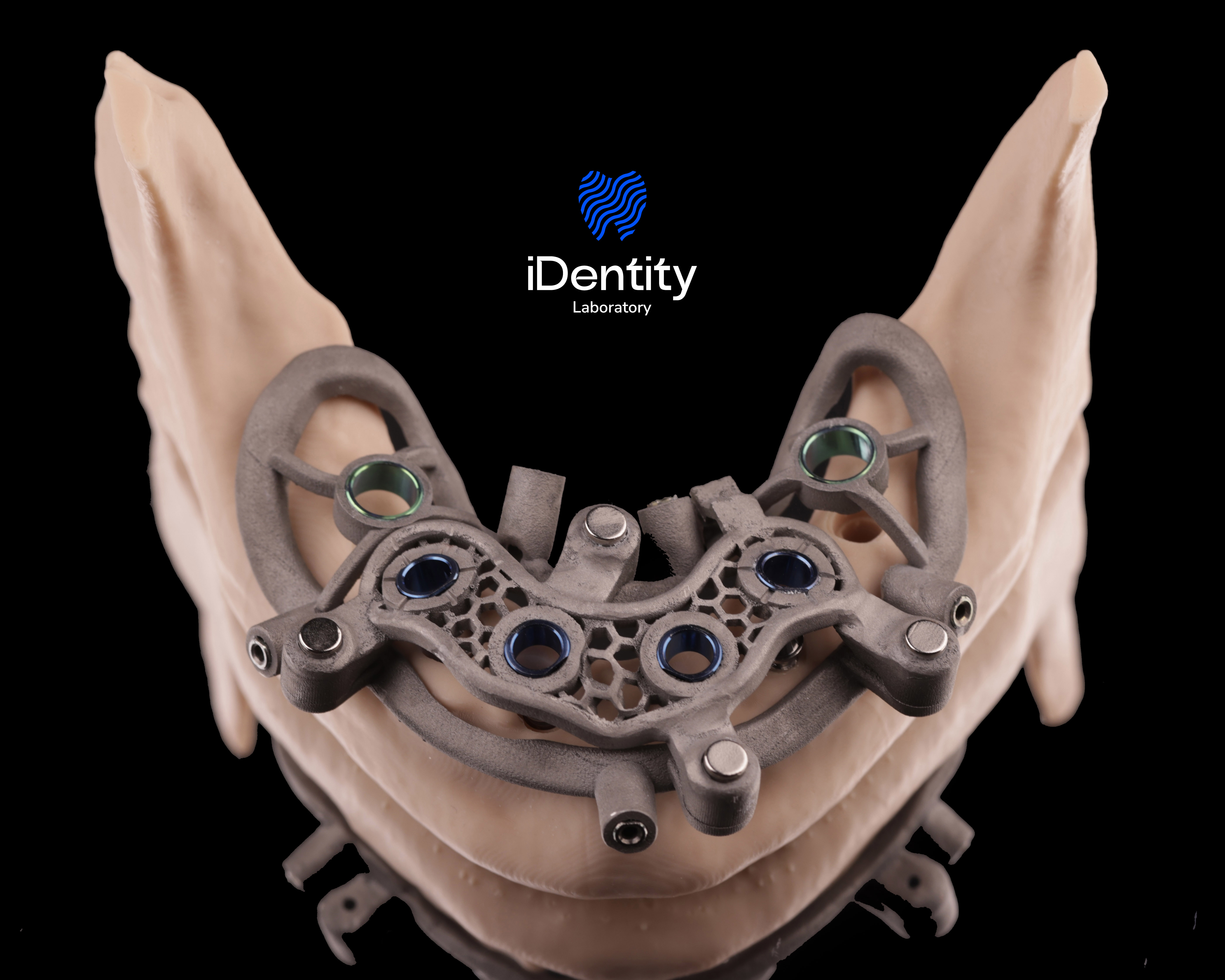 3D-printed mandibular jaw model with attached metal surgical guide used in dental implant procedures.