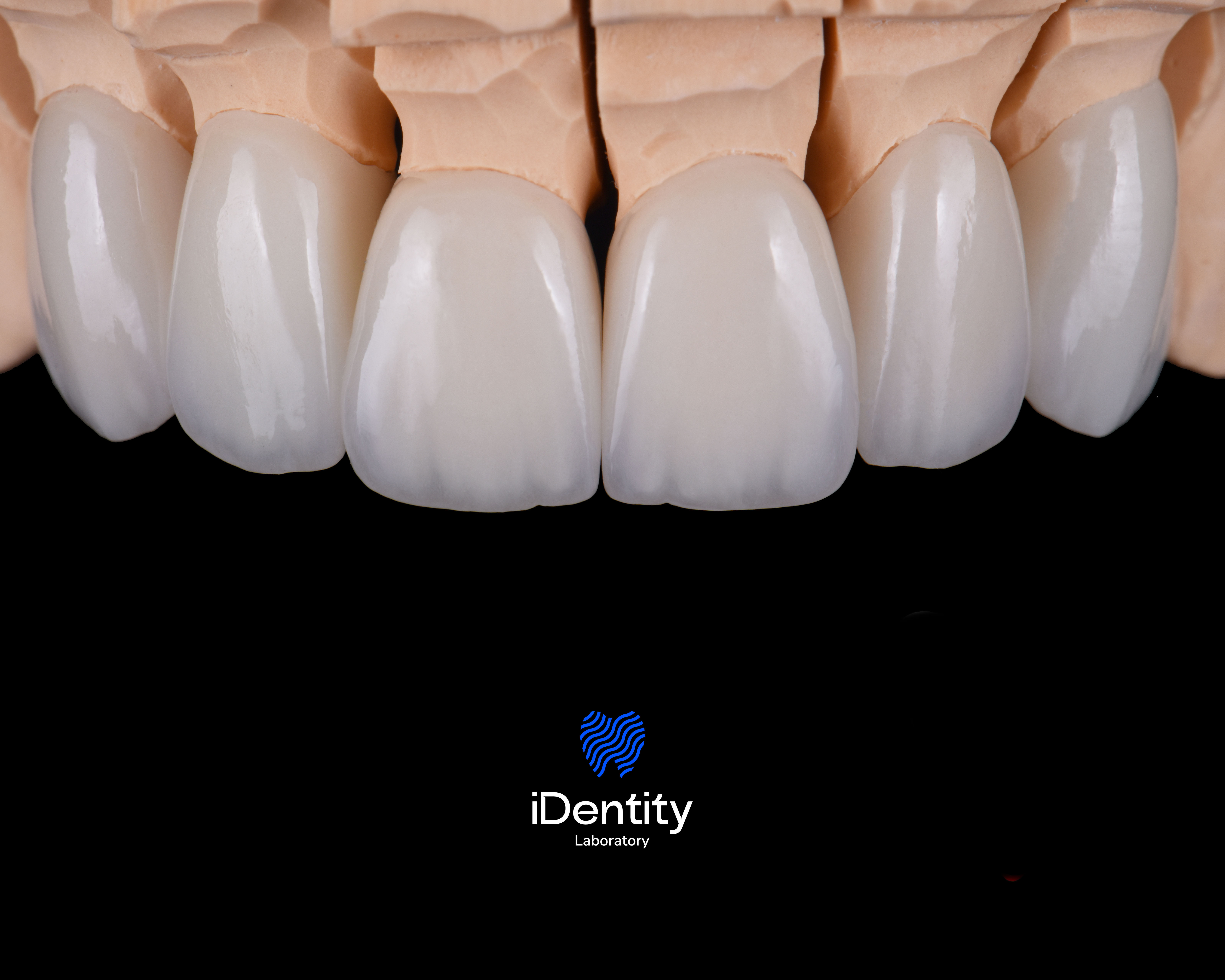 Close-up of six dental veneers on a model against a black background with iDentity Laboratory logo below.