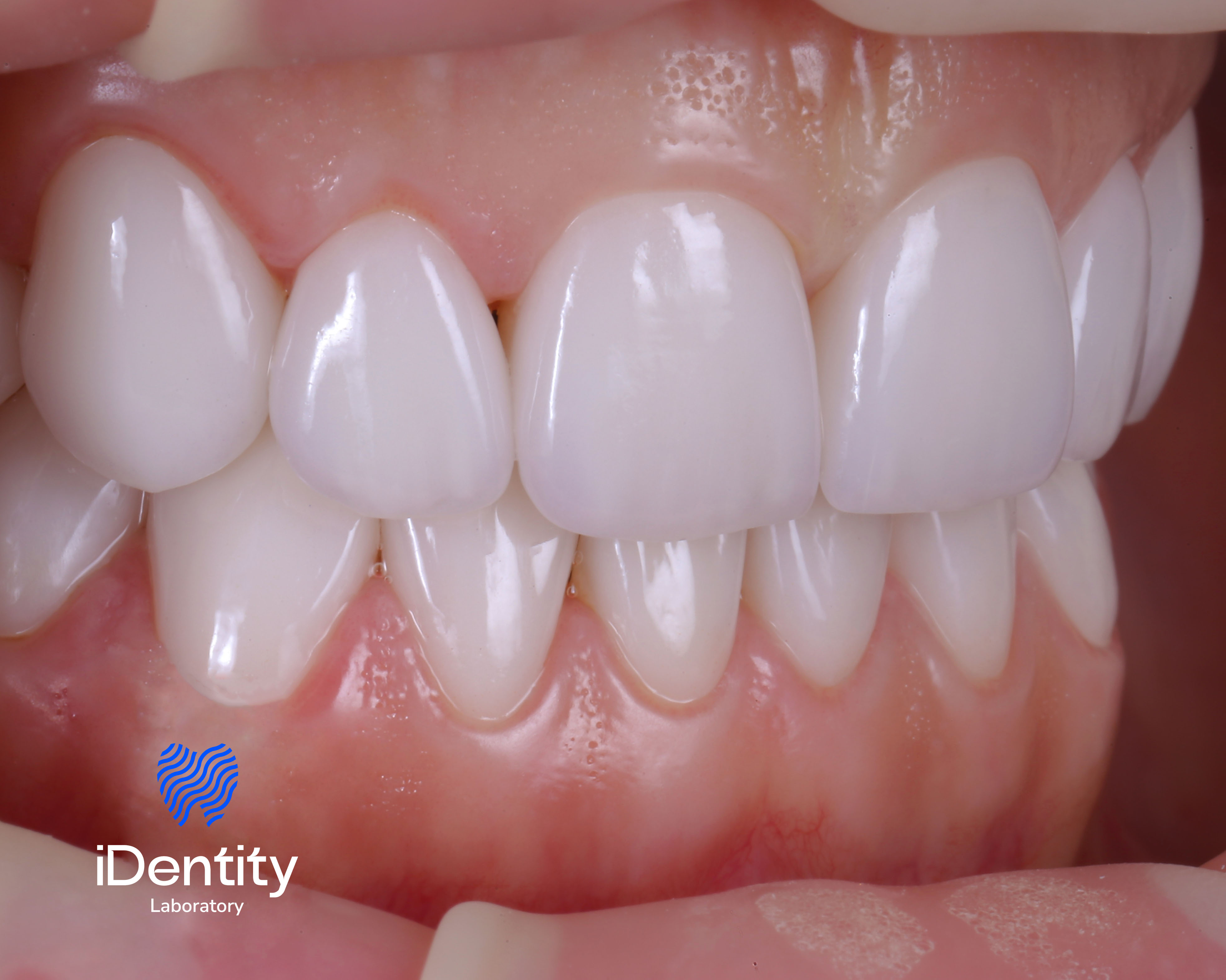 Close-up of upper and lower front teeth with healthy gums and shiny white dental veneers.
