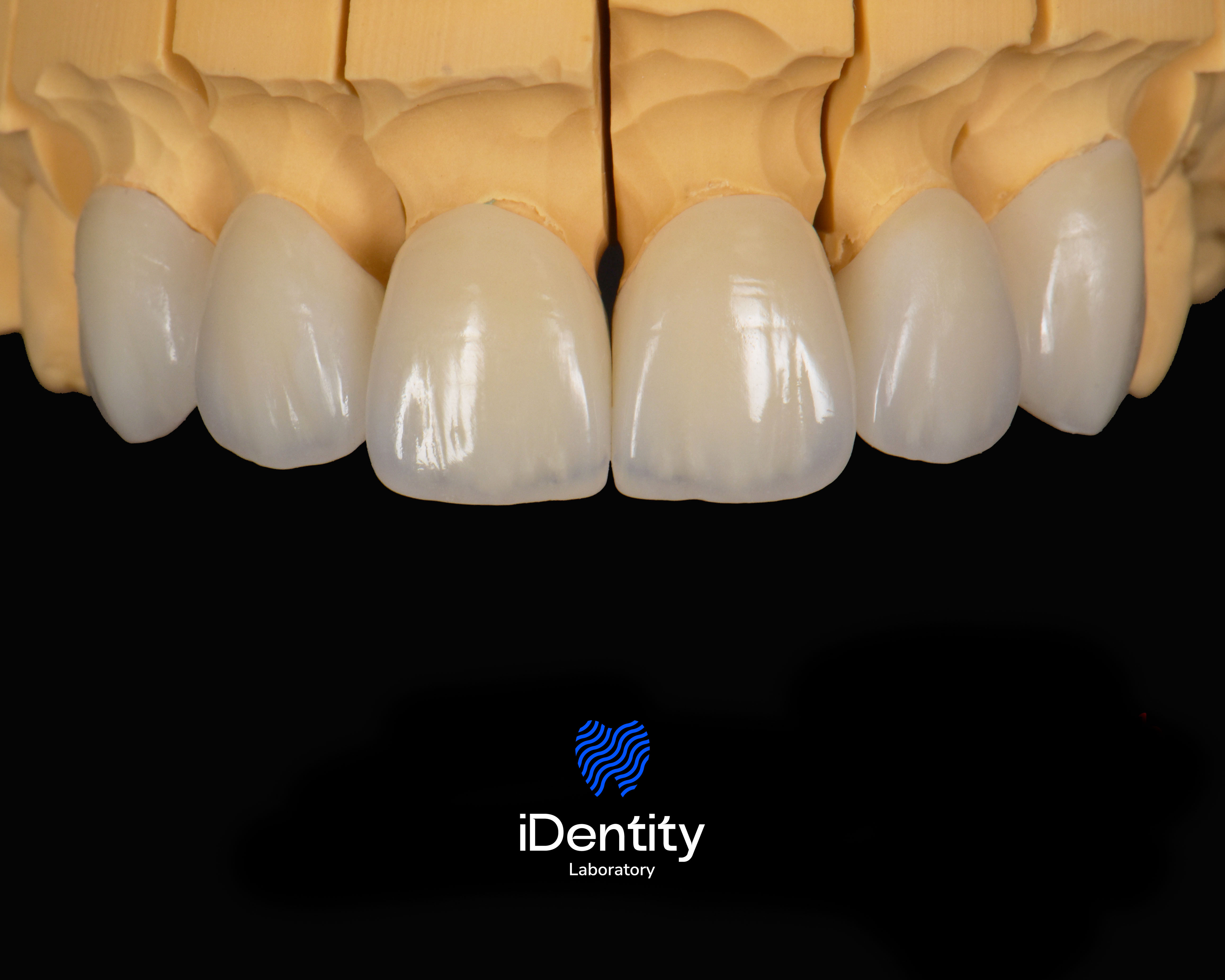 Close-up of dental prosthetic model showing six upper front teeth with realistic shading on a black background.