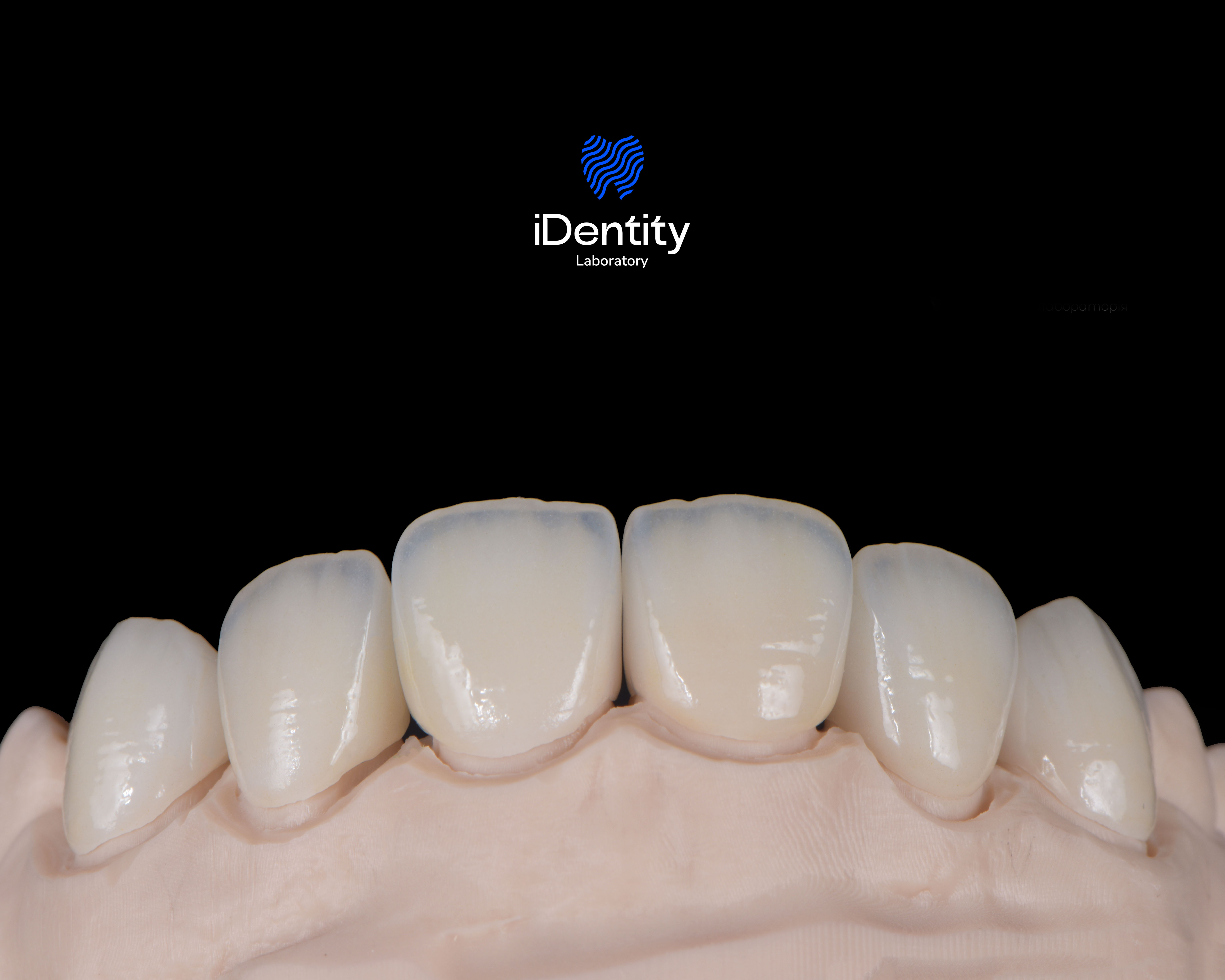 Close-up of six upper front dental crowns on a model against a black background with Identity Laboratory logo above.