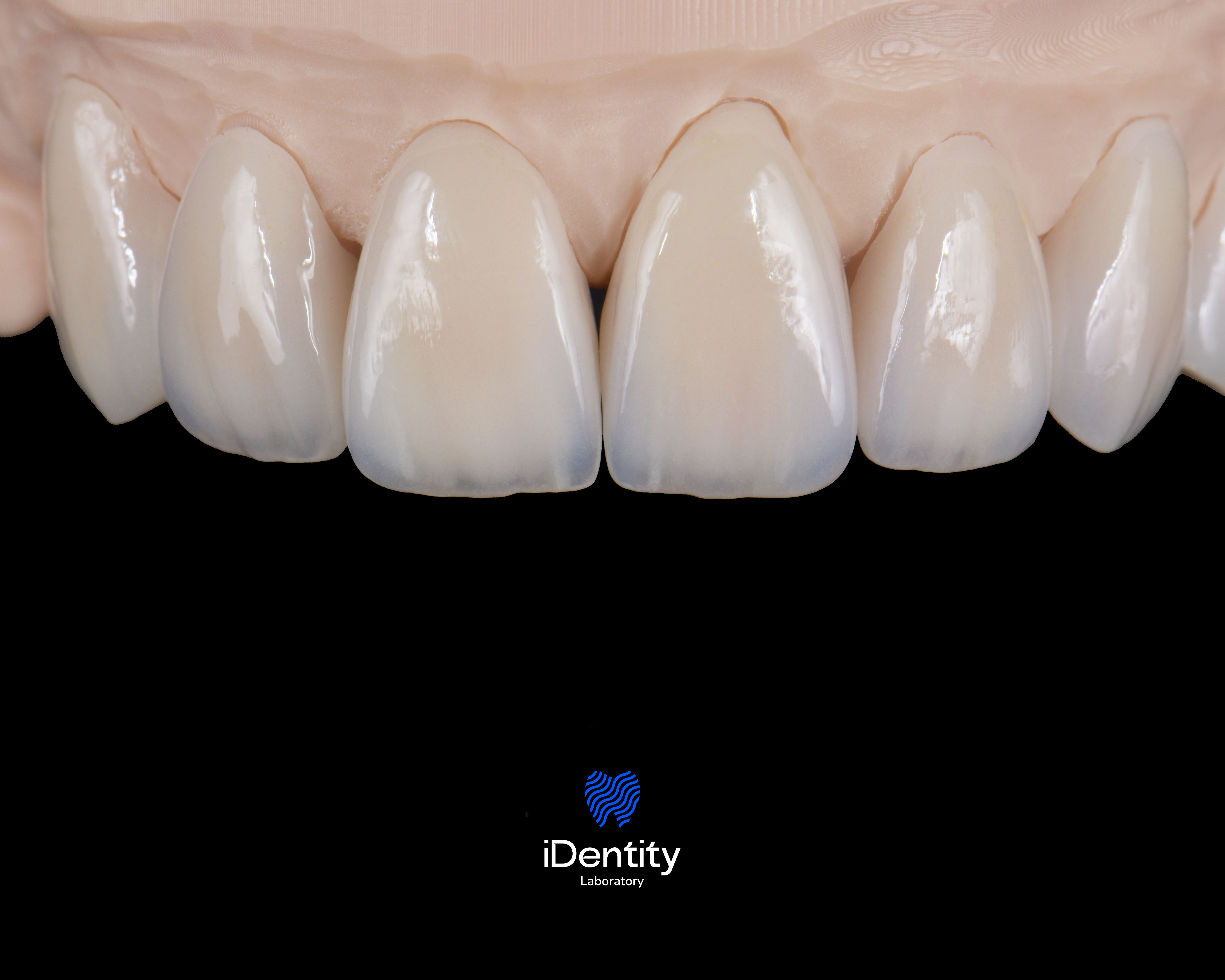 Close-up of six natural-colored dental veneers or crowns on a dental model against a black background.