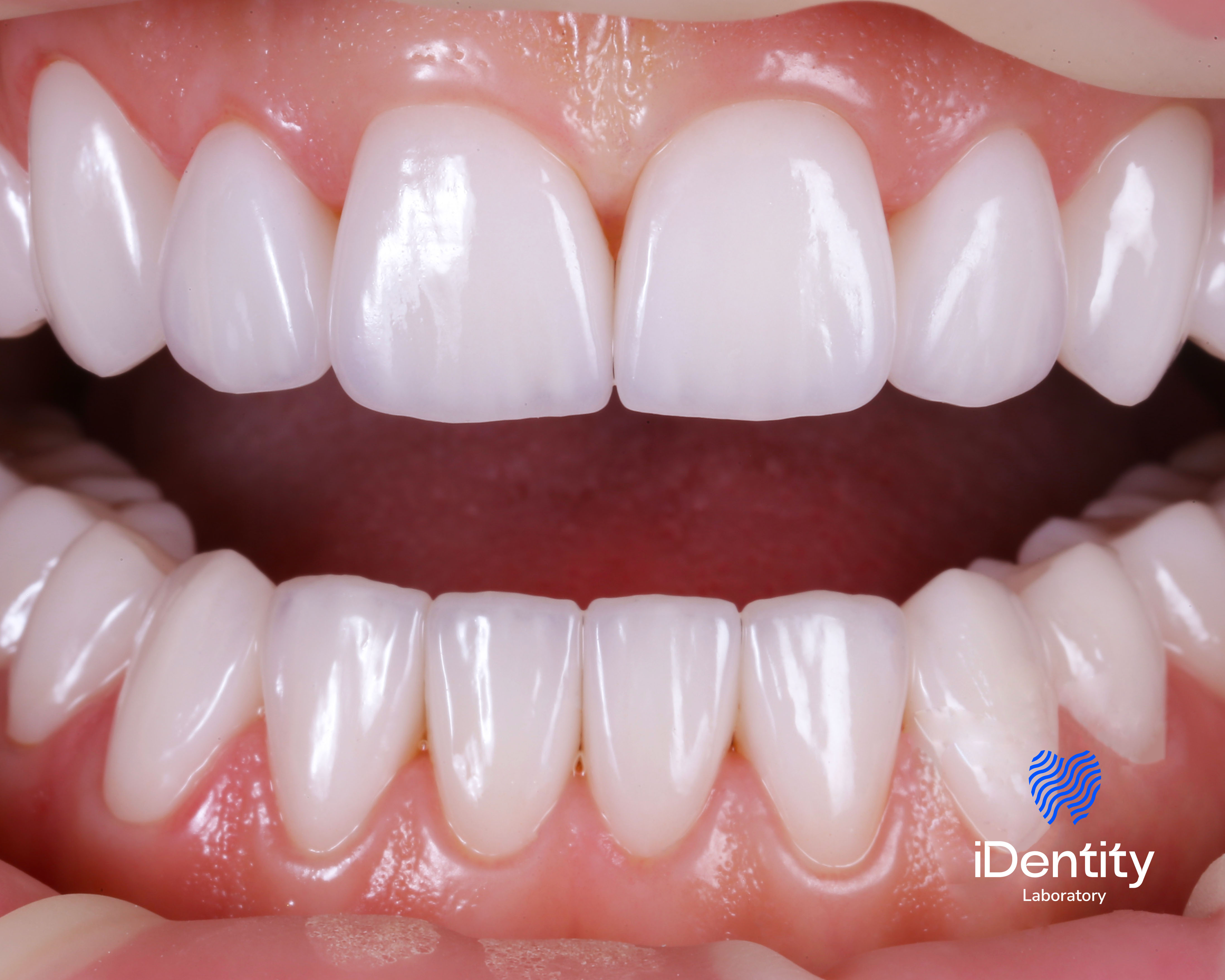 Close-up of clean, white upper and lower front teeth with healthy pink gums and a dark open mouth background.
