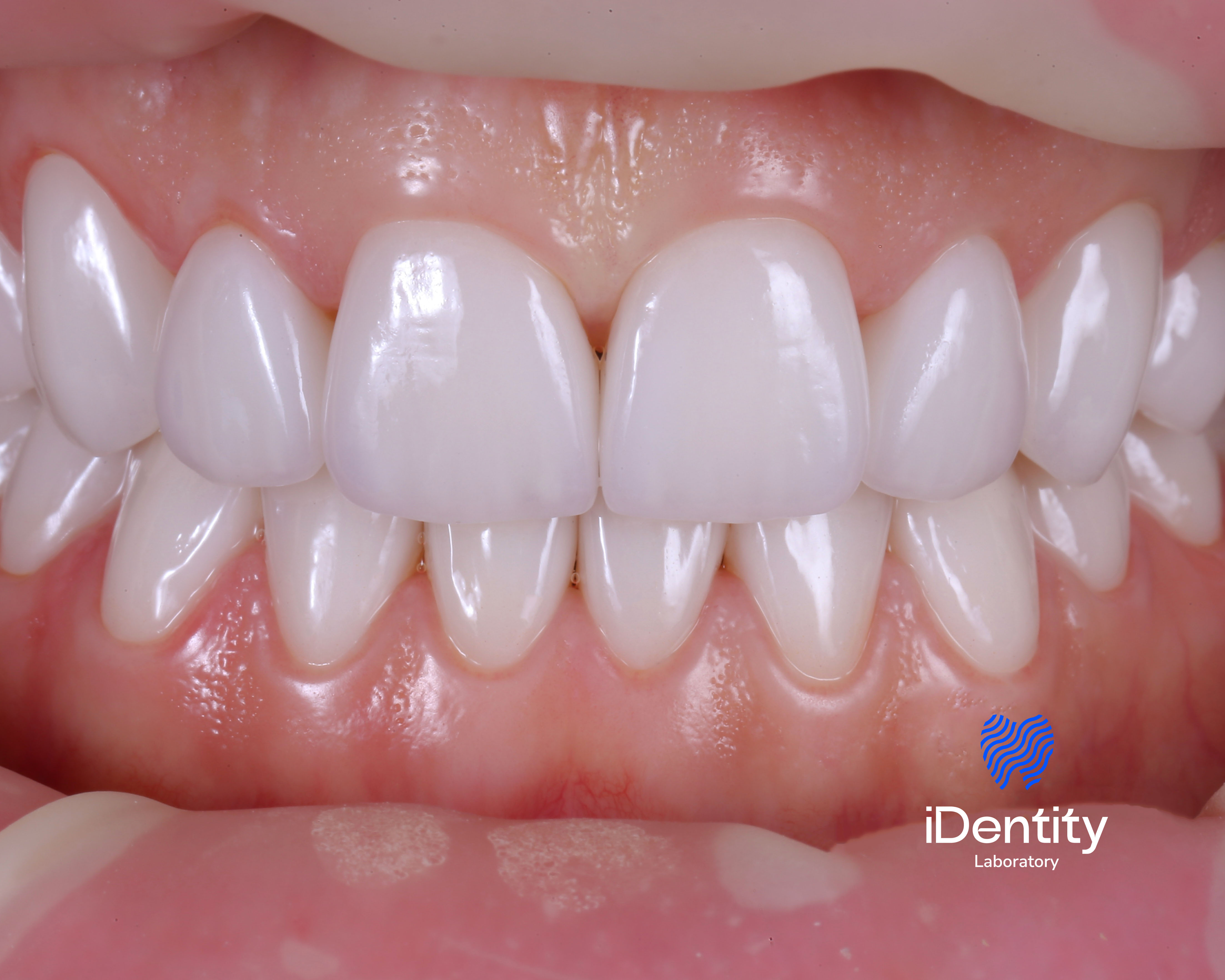 Close-up of upper and lower front teeth with healthy pink gums and a dental laboratory watermark.