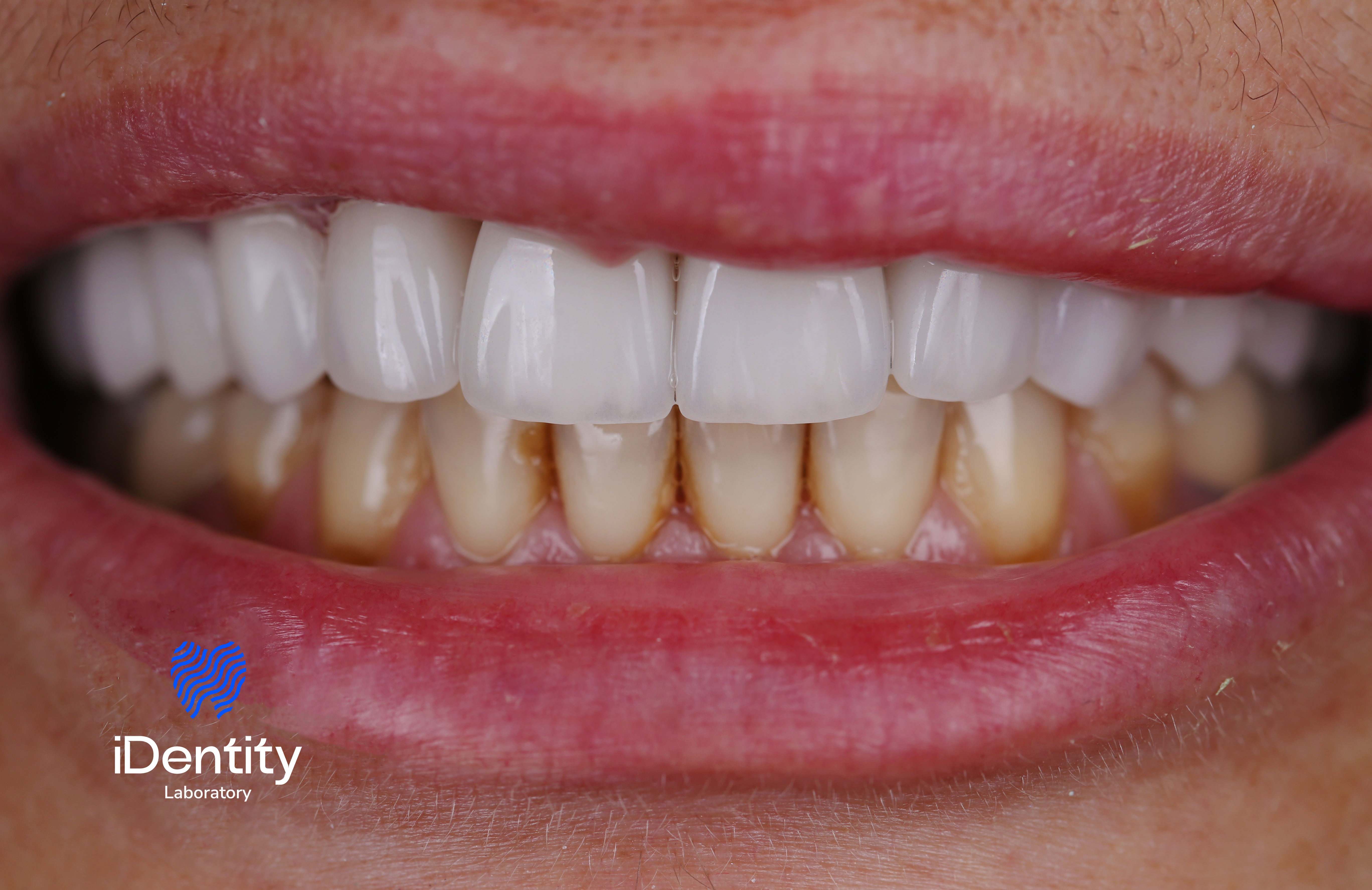 Close-up of a smile showing white upper dental veneers contrasting with natural stained lower teeth.
